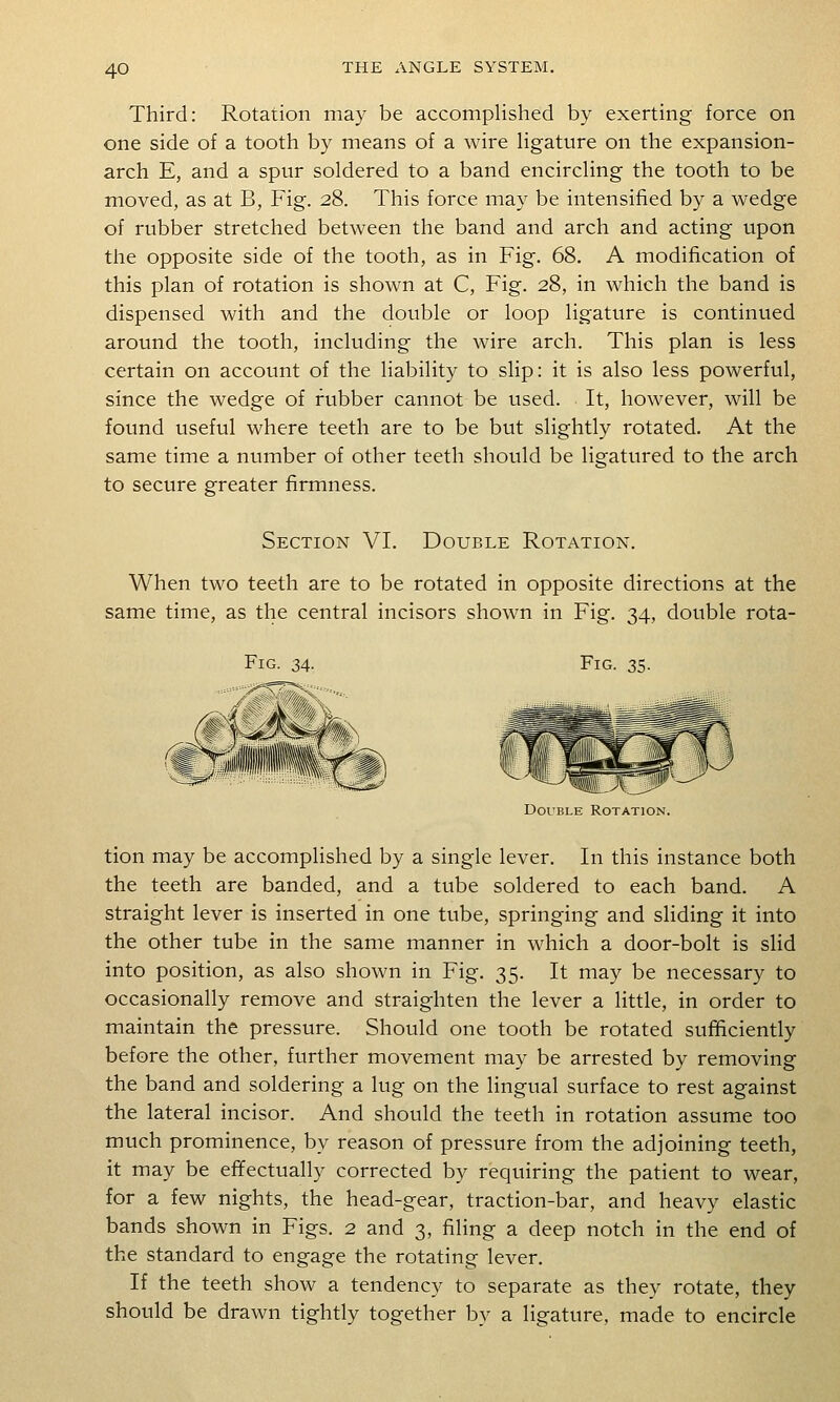 Third: Rotation may be accomplished by exerting force on one side of a tooth by means of a wire Hgature on the expansion- arch E, and a spur soldered to a band encircling the tooth to be moved, as at B, Fig. 28. This force may be intensified by a wedge of rubber stretched between the band and arch and acting upon the opposite side of the tooth, as in Fig. 68. A modification of this plan of rotation is shown at C, Fig. 28, in which the band is dispensed with and the double or loop ligature is continued around the tooth, including the wire arch. This plan is less certain on account of the liability to slip: it is also less powerful, since the wedge of rubber cannot be used. It, however, will be found useful where teeth are to be but slightly rotated. At the same time a number of other teeth should be ligatured to the arch to secure greater firmness. Section VI. Double Rotation. When two teeth are to be rotated in opposite directions at the same time, as the central incisors shown in Fig. 34, double rota- FiG. 34. Fig. 35. Double Rotation. tion may be accomplished by a single lever. In this instance both the teeth are banded, and a tube soldered to each band. A straight lever is inserted in one tube, springing and sliding it into the other tube in the same manner in which a door-bolt is slid into position, as also shown in Fig. 35. It may be necessary to occasionally remove and straighten the lever a little, in order to maintain the pressure. Should one tooth be rotated sufficiently before the other, further movement may be arrested by removing the band and soldering a lug on the lingual surface to rest against the lateral incisor. And should the teeth in rotation assume too much prominence, by reason of pressure from the adjoining teeth, it may be effectually corrected by requiring the patient to wear, for a few nights, the head-gear, traction-bar, and heavy elastic bands shown in Figs. 2 and 3, filing a deep notch in the end of the standard to engage the rotating lever. If the teeth show a tendency to separate as they rotate, they should be drawn tightly together by a ligature, made to encircle