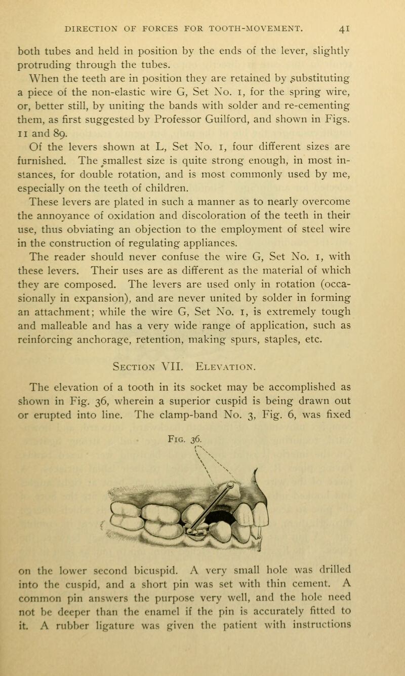 both tubes and held in position by the ends of the lever, slightly protruding through the tubes. When the teeth are in position they are retained by .substituting a piece of the non-elastic wire G, Set Xo. i, for the spring wire, or, better still, by uniting the bands with solder and re-cementing them, as first suggested by Professor Guilford, and shown in Figs. 11 and 89. Of the levers shown at L, Set No. i, four different sizes are furnished. The smallest size is quite strong enough, in most in- stances, for double rotation, and is most conmionly used by me, especially on the teeth of children. These levers are plated in such a manner as to nearly overcome the annoyance of oxidation and discoloration of the teeth in their use, thus obviating an objection to the employment of steel wire in the construction of regulating appliances. The reader should never confuse the wire G, Set No. i, with these levers. Their uses are as different as the material of which they are composed. The levers are used only in rotation (occa- sionally in expansion), and are never united by solder in forming an attachment; while the wire G, Set No. i, is extremely tough and malleable and has a very wide range of application, such as reinforcing anchorage, retention, making spurs, staples, etc. Section VH. Elevation. The elevation of a tooth in its socket may be accomplished as shown in Fig. 36, wherein a superior cuspid is being drawn out or erupted into line. The clamp-band No. 3, Fig. 6, was fixed Fig. 36. on the lower second bicuspid. A very small hole was drilled into the cuspid, and a short pin was set with thin cement. A common pin answers the purpose very well, and the hole need not be deeper than the enamel if the pin is accurately fitted to it. A rubber ligature was given the patient with instructions