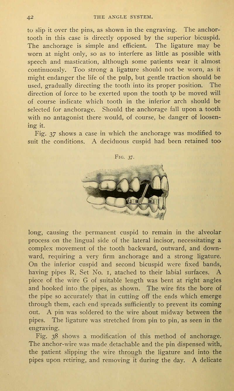 to slip it over the pins, as shown in the engraving. The anchor- tooth in this case is directly opposed by the superior bicuspid. The anchorage is simple and efficient. The ligature may be worn at night only, so as to interfere as little as possible with speech and mastication, although some patients wear it almost continuously. Too strong a ligature should not be worn, as it might endanger the life of the pulp, but gentle traction should be used, gradually directing the tooth into its proper position. The direction of force to be exerted upon the tooth to be moved will of course indicate which tooth in the inferior arch should be selected for anchorage. Should the anchorage fall upon a tooth with no antagonist there would, of course, be danger of loosen- ing it. Fig. 37 shows a case in which the anchorage was modified tO' suit the conditions. A deciduous cuspid had been retained too Fig. zt. long, causing the permanent cuspid to remain in the alveolar process on the lingual side of the lateral incisor, necessitating a complex movement of the tooth backward, outward, and down- ward, requiring a very firm anchorage and a strong ligature. On the inferior cuspid and second bicuspid were fixed bands,, having pipes R, Set No. i, atached to their labial surfaces. A piece of the wire G of suitable length was bent at right angles and hooked into the pipes, as shown. The wire fits the bore of the pipe so accurately that in cutting off the ends which emerge through them, each end spreads sufficiently to prevent its coming out. A pin was soldered to the wire about midway between the pipes. The ligature was stretched from pin to pin, as seen in the engraving. Fig. 38 shows a modification of this method of anchorage. The anchor-wire was made detachable and the pin dispensed with, the patient slipping the wire through the ligature and into the pipes upon retiring, and removing it during the day. A delicate