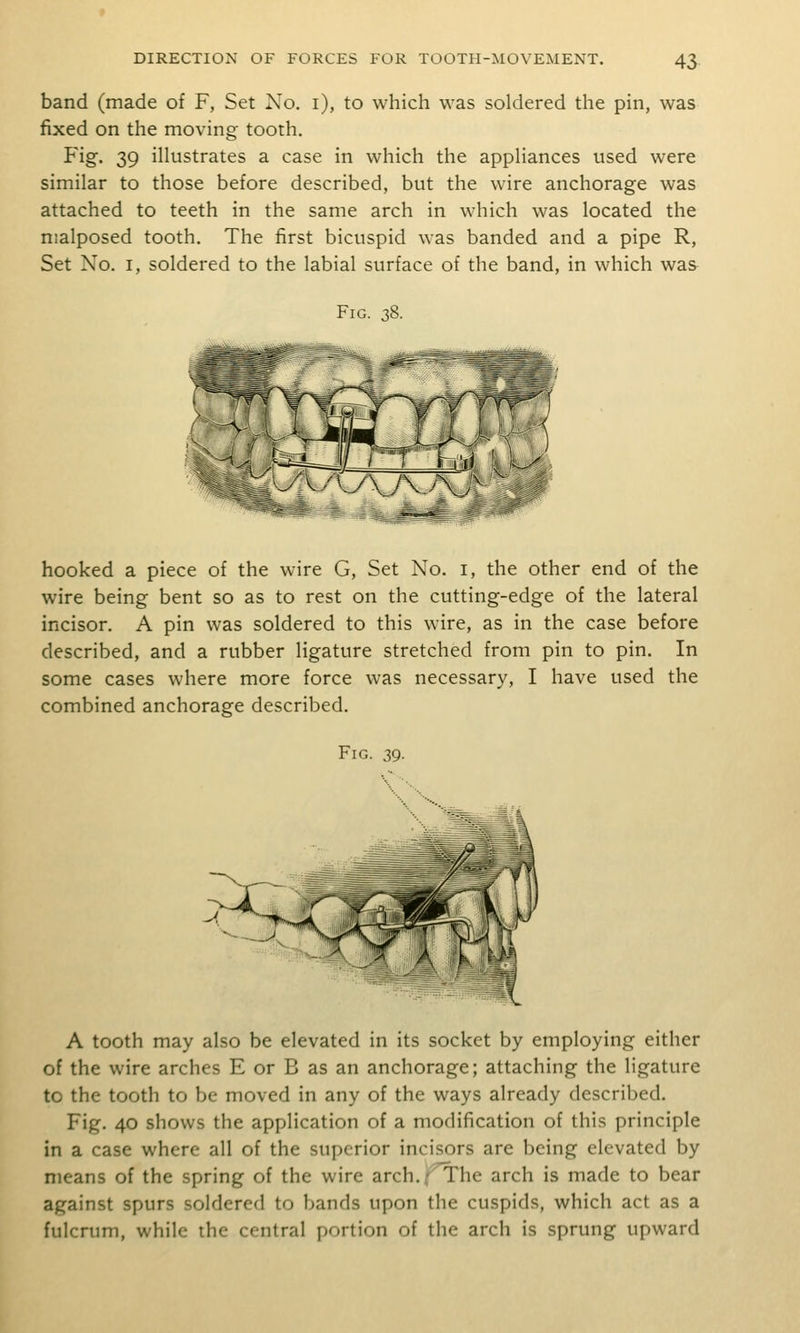 band (made of F, Set Xo. i), to which was soldered the pin, was fixed on the moving tooth. Fig. 39 ilkistrates a case in which the appHances used were similar to those before described, but the wire anchorage was attached to teeth in the same arch in which was located the malposed tooth. The first bicuspid was banded and a pipe R, Set No. I, soldered to the labial surface of the band, in which was Fig. 38. hooked a piece of the wire G, Set No. i, the other end of the wire being bent so as to rest on the cutting-edge of the lateral incisor. A pin was soldered to this wire, as in the case before described, and a rubber ligature stretched from pin to pin. In some cases where more force was necessary, I have used the combined anchorage described. Fig. 39. ^^Sf*' ^il A tooth may also be elevated in its socket by employing either of the wire arches E or B as an anchorage; attaching the ligature to the tooth to be moved in any of the ways already described. Fig. 40 shows the application of a modification of this principle in a case where all of the superior incisors are being elevated by means of the spring of the wire arch.;( The arch is made to bear against spurs soldered to bands upon the cuspids, which act as a fulcrum, while the central portion of the arch is sprung upward