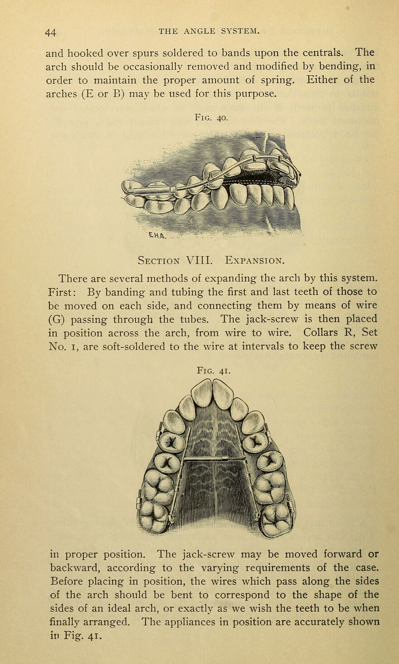 and hooked over spurs soldered to bands upon the centrals. The arch should be occasionally removed and modified by bending, in order to maintain the proper amount of spring. Either of the arches (E or B) may be used for this purpose. Fig. 40. f-MA Section VIII. Expansion. There are several methods of expanding the arch by this system. First: By banding and tubing the first and last teeth of those to be moved on each side, and connecting them by means of wire (G) passing through the tubes. The jack-screw is then placed in position across the arch, from wire to wire. Collars R, Set No. I, are soft-soldered to the wire at intervals to keep the screw Fig. 41. in proper position. The jack-screw may be moved forward or backward, according to the varying requirements of the case. Before placing in position, the wires which pass along the sides of the arch should be bent to correspond to the shape of the sides of an ideal arch, or exactly as we wish the teeth to be when finally arranged. The appliances in position are accurately shown in Fig. 41.