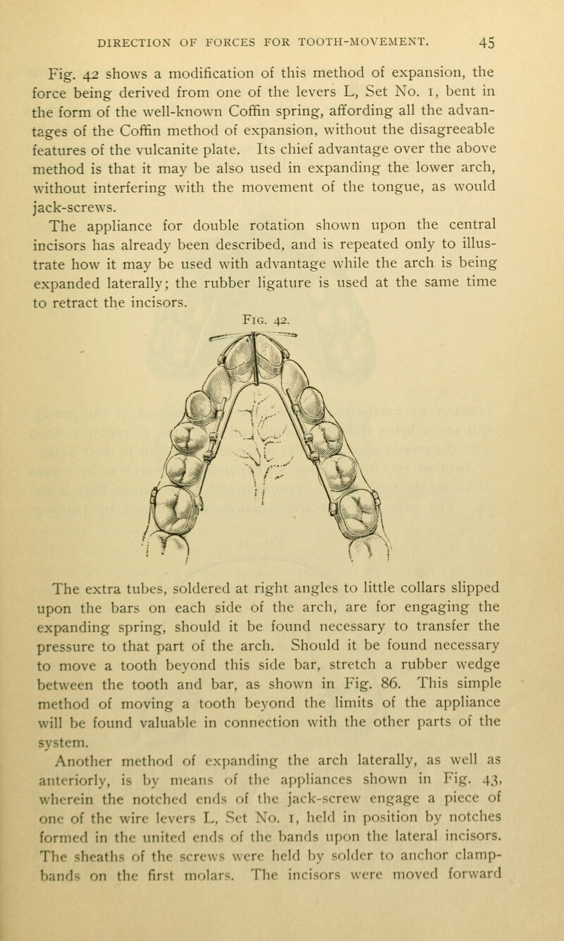 Fig. 42 shows a modification of this method of expansion, the force being derived from one of the levers L, Set No. i, bent in the form of the well-known Coffin spring, affording all the advan- tages of the Coffin method of expansion, without the disagreeable features of the vulcanite plate. Its chief advantage over the above method is that it may be also used in expanding the lower arch, without interfering with the movement of the tongue, as would jack-screws. The appliance for double rotation shown upon the central incisors has already been described, and is repeated only to illus- trate how it may be used with advantage while the arch is being expanded laterally; the rubber ligature is used at the same time to retract the incisors. Fig. 42. The extra tubes, soldered at right angles to little collars slipped upon the bars on each side of the arch, are for engaging the expanding spring, should it be found necessary to transfer the pressure to that part of the arch. Should it be found necessary to move a tooth beyond this side bar, stretch a rubber wedge between the tooth and bar, as shown in Fig. 86. This simple method of moving a tooth beyond the limits of the appliance will be found valuable in connection with the other parts of the system. Another method of expanding the arch laterally, as well as anteriorly, is by means of the appliances shown in Fig. 43, wherein the notched ends of the jack-screw engage a piece of one of the wire levers L, Set No. i, held in position by notches formed in the united ends of the bands upon the lateral incisors. The sheaths of the screws were held by solder to anchor clamp- bands on the first molars. The incisors were moved forward