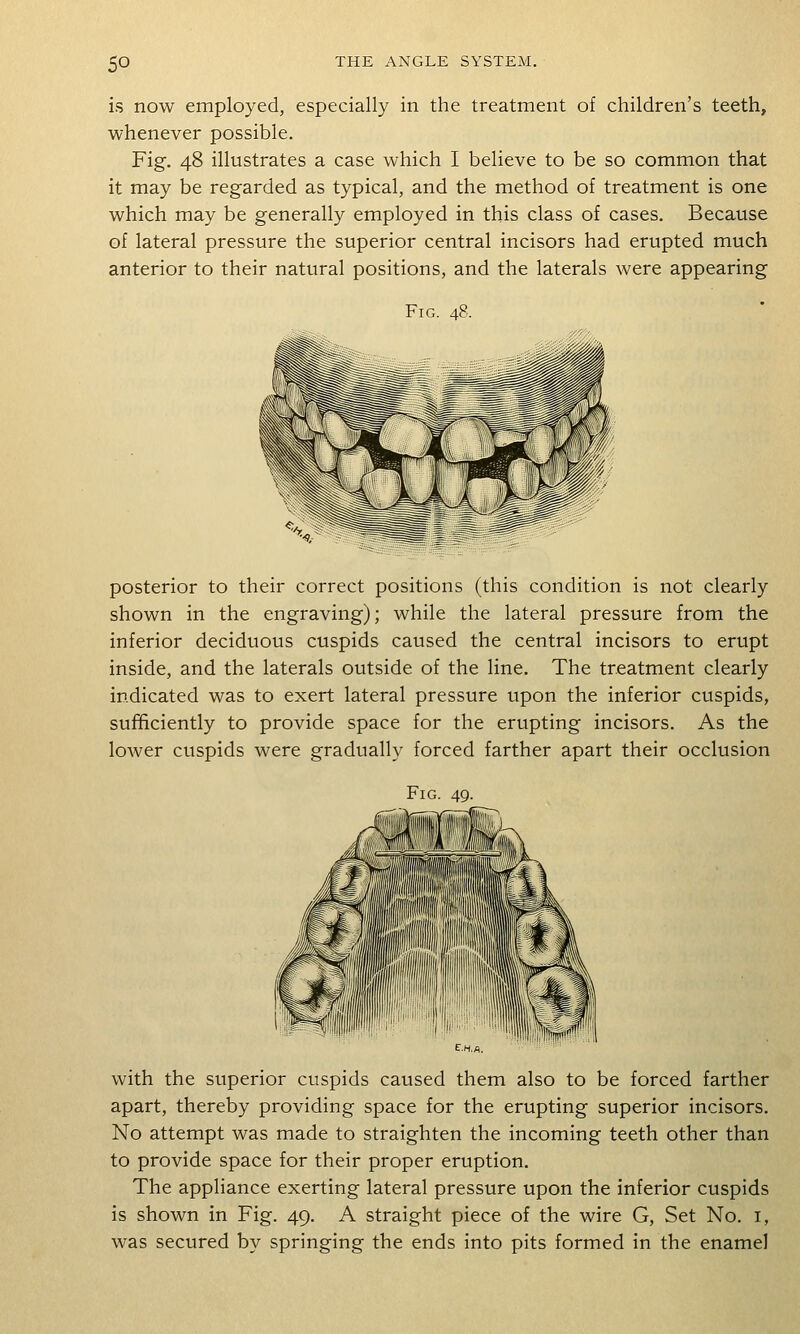 is now employed, especially in the treatment of children's teeth, whenever possible. Fig. 48 illustrates a case which I believe to be so common that it may be regarded as typical, and the method of treatment is one which may be generally employed in this class of cases. Because of lateral pressure the superior central incisors had erupted much anterior to their natural positions, and the laterals were appearing Fig. 48. posterior to their correct positions (this condition is not clearly shown in the engraving); while the lateral pressure from the inferior deciduous cuspids caused the central incisors to erupt inside, and the laterals outside of the line. The treatment clearly indicated was to exert lateral pressure upon the inferior cuspids, sufQciently to provide space for the erupting incisors. As the lower cuspids were gradually forced farther apart their occlusion Fig with the superior cuspids caused them also to be forced farther apart, thereby providing space for the erupting superior incisors. No attempt was made to straighten the incoming teeth other than to provide space for their proper eruption. The appliance exerting lateral pressure upon the inferior cuspids is shown in Fig. 49. A straight piece of the wire G, Set No. i, was secured by springing the ends into pits formed in the enamel