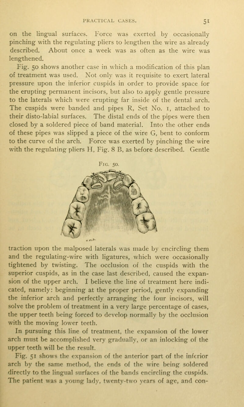 on the lingual surfaces. Force was exerted by occasionally pinching with the regulating pliers to lengthen the wire as already described. About once a week was as often as the wire was lengthened. Fig. 50 shows another case in which a modification of this plan of treatment was used. Not only was it requisite to exert lateral pressure upon the inferior cuspids in order to provide space for the erupting permanent incisors, but also to apply gentle pressure to the laterals which were erupting far inside of the dental arch. The cuspids were banded and pipes R, Set No. i, attached to their disto-labial surfaces. The distal ends of the pipes were then closed by a soldered piece of band material. Into the other ends of these pipes was slipped a piece of the wire G, bent to conform to the curve of the arch. Force was exerted by pinching the wire with the regulating pliers H, Fig. 8 B, as before described. Gentle Fig. 50. traction upon the malposed laterals was made by encircling them and the regulating-wire with ligatures, which were occasionally tightened by twisting. The occlusion of the cuspids with the superior cuspids, as in the case last described, caused the expan- sion of the upper arch. I believe the line of treatment here indi- cated, namely: beginning at the proper period, gently expanding the inferior arch and perfectly arranging the four incisors, will solve the problem of treatment in a very large percentage of cases, the upper teeth being forced to develop normally by the occlusion with the moving lower teeth. In pursuing this line of treatment, the expansion of the lower arch must be accomplished very gradually, or an inlocking of the upper teeth will be the result. Fig. 51 shows the expansion of the anterior part of the inferior arch by the same method, the ends of the wire being soldered directly to the Ungual surfaces of the bands encircling the cuspids. The patient was a young lady, twenty-two years of age, and con-