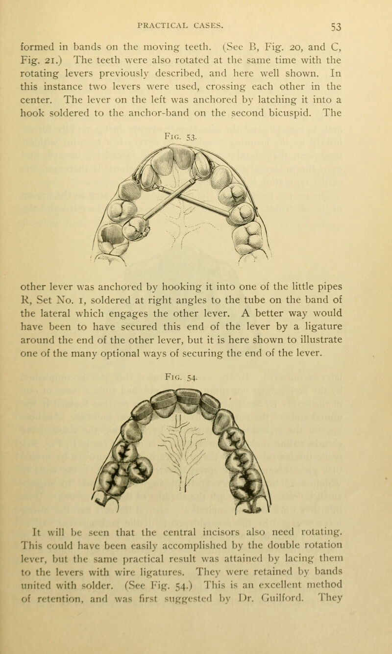 formed in bands on the moving teeth. (See B, Fig. 20, and C, Fig. 21.) The teeth were also rotated at the same time with the rotating levers previously described, and here well shown. In this instance two levers were used, crossing each other in the center. The lever on the left was anchored by latching it into a hook soldered to the anchor-band on the second bicuspid. The Fig. 53. other lever was anchored by hooking it into one of the little pipes R, Set Xo. I, soldered at right angles to the tube on the band of the lateral which engages the other lever, A better way would have been to have secured this end of the lever by a ligature around the end of the other lever, but it is here shown to illustrate one of the many optional ways of securing the end of the lever. Fig. 54. It will be .seen that the central incisors also need rotating. This could have been easily accomplished by the double rotation lever, but the same practical result was attained by lacing them to the levers with wire ligatures. They were retained by bands united with solder. (See Fig, 54,) This is an excellent method of retention, and was first suggested by Dr. Guilford. They