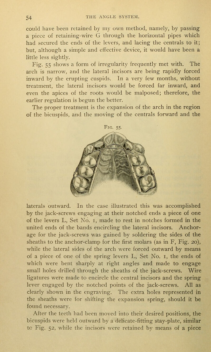 could have been retained by my own method, namely, by passing a piece of retaining-wire G through the horizontal pipes which had secured the ends of the levers, and lacing the centrals to it; but, although a simple and effective device, it would have been a little less sightly. Fig. 55 shows a form of irregularity frequently met with. The arch is narrow, and the lateral incisors are being rapidly forced inward by the erupting cuspids. In a very few months, without treatment, the lateral incisors would be forced far inward, and even the apices of the roots would be malposed; therefore, the earlier regulation is begun the better. The proper treatment is the expansion of the arch in the region of the bicuspids, and the moving of the centrals forward and the Fig. 55- laterals outward. In the case illustrated this was accomplished by the jack-screws engaging at their notched ends a piece of one of the levers L, Set No. i, made to rest in notches formed in the united ends of the bands encircling the lateral incisors. Anchor- age for the jack-screws was gained by soldering the sides of the sheaths to the anchor-clamp for the first molars (as in F, Fig. 20), while the lateral sides of the arch were forced outward by means of a piece of one of the spring levers L, Set No. i, the ends of which were bent sharply at right angles and made to engage small holes drilled through the sheaths of the jack-screws. Wire ligatures were made to encircle the central incisors and the spring lever engaged by the notched points of the jack-screws. All as clearly shown in the engraving. The extra holes represented in the sheaths were for shifting the expansion spring, should it be found necessary. After the teeth had been moved into their desired positions, the bicuspids were held outward by a delicate-fitting stay-plate, similar to Fig. 52, while the incisors were retained by means of a piece