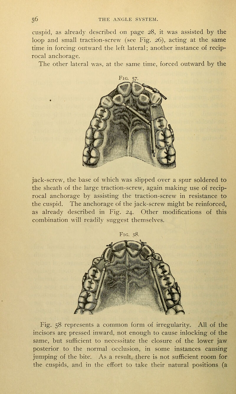 cuspid, as already described on page 28, it was assisted by the loop and small traction-screw (see Fig. 26), acting at the same time in forcing outward the left lateral; another instance of recip- rocal anchorage. The other lateral was, at the same time, forced outward by the Fig jack-screw, the base of which was slipped over a spur soldered to the sheath of the large traction-screw, again making use of recip- rocal anchorage by assisting the traction-screw in resistance to the cuspid. The anchorage of the jack-screw might be reinforced, as already described in Fig. 24. Other modifications of this combination will readily suggest themselves. Fig. 58 represents a common form of irregularity. All of the incisors are pressed inward, not enough to cause inlocking of the same, but sufficient to necessitate the closure of the lower jaw posterior to the normal occlusion, in some instances causing jumping of the bite. As a result, there is not sufficient room for the cuspids, and in the effort to take their natural positions (a