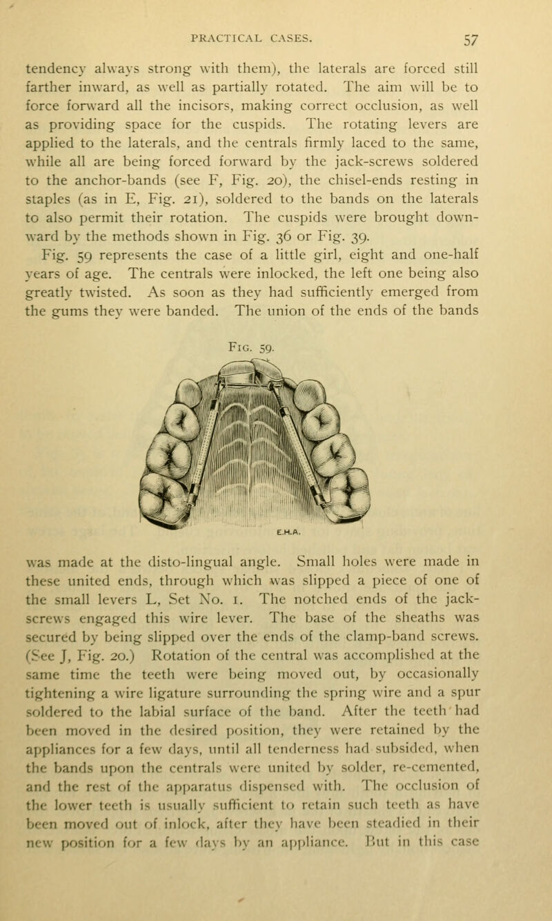 tendency always strong with them), the laterals are forced still farther inward, as well as partially rotated. The aim will be to force forward all the incisors, making correct occlusion, as well as providing space for the cuspids. The rotating levers are applied to the laterals, and the centrals firmly laced to the same, while all are being forced forward by the jack-screws soldered to the anchor-bands (see F, Fig. 20), the chisel-ends resting in staples (as in E, Fig. 21), soldered to the bands on the laterals to also permit their rotation. The cuspids were brought dow'n- ward by the methods shown in Fig. 36 or Fig. 39. Fig. 59 represents the case of a little girl, eight and one-half years of age. The centrals were inlocked, the left one being also greatly twisted. As soon as they had sufficiently emerged from the gums they weie banded. The union of the ends of the bands Fig. 59. was made at the disto-lingual angle. Small holes were made in these united ends, through which was slipped a piece of one of the small levers L, Set No. i. The notched ends of the jack- screws engaged this wire lever. The base of the sheaths was secured by being slipped over the ends of the clamp-band screws. (See J, Fig. 20.) Rotation of the central was accomplished at the same time the teeth were being moved out, by occasionally tightening a wire ligature surrounding the spring wire and a spur soldered to the labial surface of the band. After the teeth had been moved in the desired position, they were retained by the ai)pliances for a few days, until all tenderness had subsided, when the bands upon the centrals were united by solder, re-cemented, and the rest of the apparatus dispensed with. The occlusion of the lower teeth is usually sufficient to retain such teeth as have been moved out of inlock, after they have been steadied in their new position U>r a few days by an ai)j)liancc. T>ut in this case