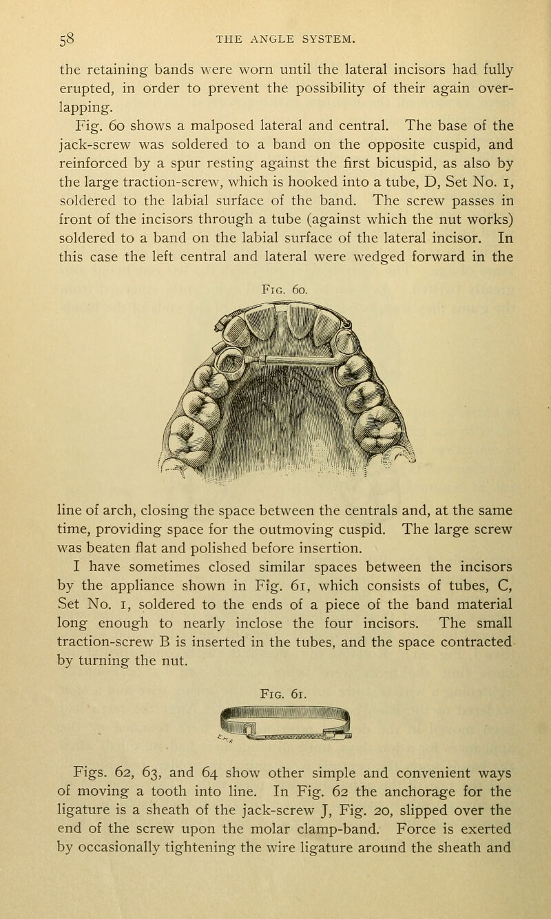 the retaining bands were worn until the lateral incisors had fully erupted, in order to prevent the possibility of their again over- lapping. Fig. 60 shows a malposed lateral and central. The base of the jack-screw was soldered to a band on the opposite cuspid, and reinforced by a spur resting against the first bicuspid, as also by the large traction-screw, which is hooked into a tube, D, Set No. i, soldered to the labial surface of the band. The screw passes in front of the incisors through a tube (against which the nut works) soldered to a band on the labial surface of the lateral incisor. In this case the left central and lateral were wedged forward in the Fig. 60. line of arch, closing the space between the centrals and, at the same time, providing space for the outmoving cuspid. The large screw was beaten flat and polished before insertion. I have sometimes closed similar spaces between the incisors by the appliance shown in Fig. 61, which consists of tubes, C, Set No. I, soldered to the ends of a piece of the band material long enough to nearly inclose the four incisors. The small traction-screw B is inserted in the tubes, and the space contracted by turning the nut. Fig. 61. Figs. 62, 63, and 64 show other simple and convenient ways of moving a tooth into line. In Fig. 62 the anchorage for the ligature is a sheath of the jack-screw J, Fig. 20, slipped over the end of the screw upon the molar clamp-band. Force is exerted by occasionally tightening the wire ligature around the sheath and