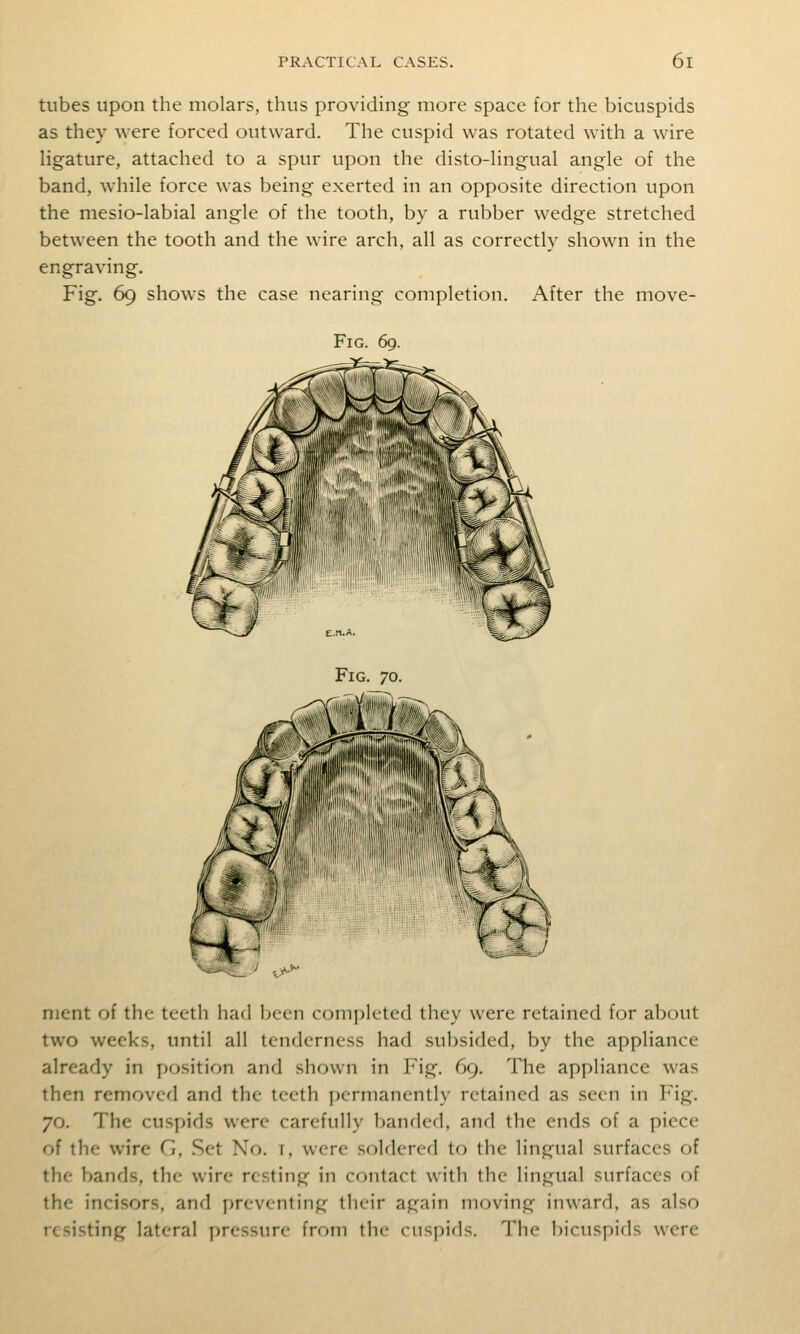 tubes upon the molars, thus providing more space for the bicuspids as they were forced outward. The cuspid was rotated with a wire Hgature, attached to a spur upon the disto-Hngual angle of the band, while force was being exerted in an opposite direction upon the mesio-labial angle of the tooth, by a rubber wedge stretched between the tooth and the wire arch, all as correctly shown in the engraving. Fig. 69 shows the case nearing completion. After the move- FiG. 69. nient of the teeth had been completed they were retained for about two weeks, until all tenderness had subsided, by the appliance already in position and shown in Fig. 69. The appliance was then removed and the teeth permanently retained as seen in Fig. 70. The cuspids were carefully banded, and the ends of a piece of the wire G, Set No. t, were soldered to the lingual surfaces of the bands, the wire resting in contact with the lingual surfaces of the incisors, and preventing their again moving inward, as also resisting lateral pressure from the cuspids. The bicuspids were