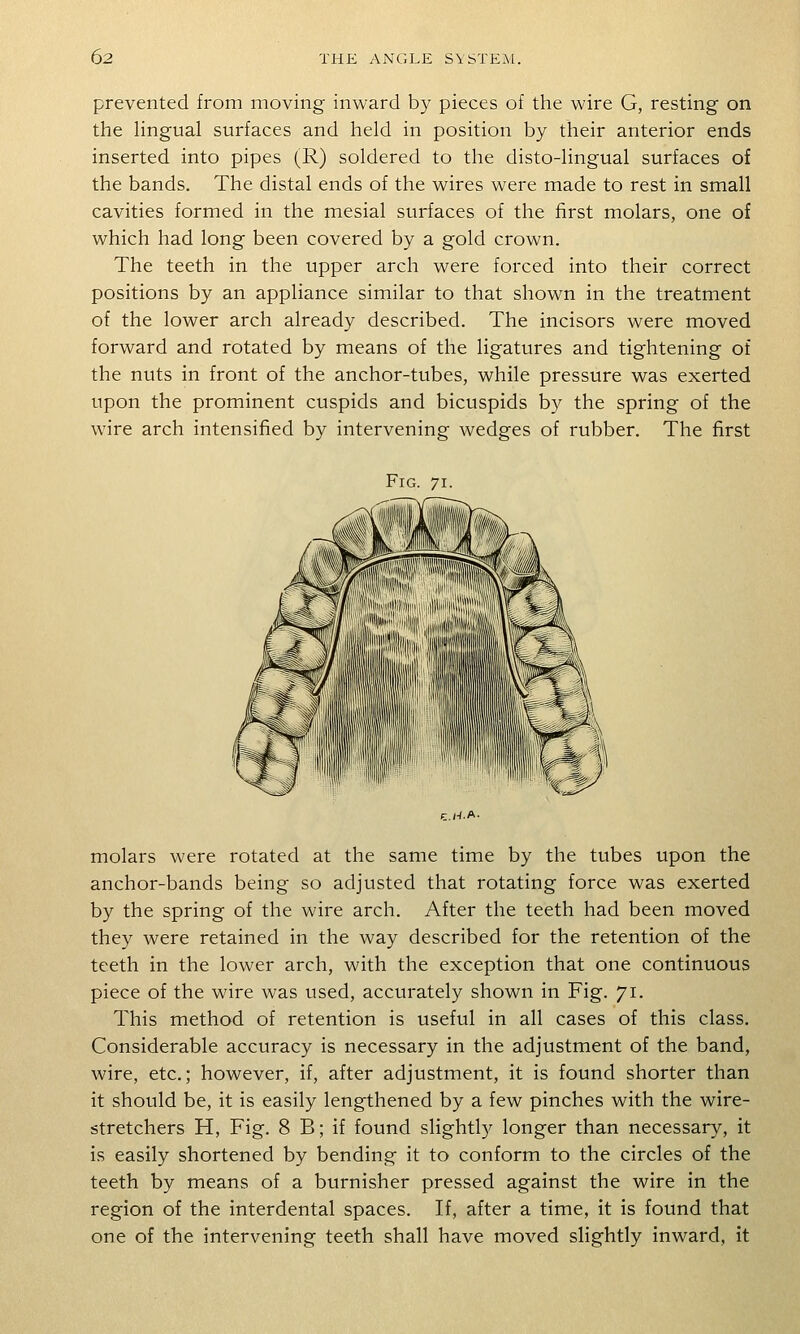 prevented from moving inward by pieces of the wire G, resting on the Ungual surfaces and held in position by their anterior ends inserted into pipes (R) soldered to the disto-lingual surfaces of the bands. The distal ends of the wires were made to rest in small cavities formed in the mesial surfaces of the first molars, one of which had long been covered by a gold crown. The teeth in the upper arch were forced into their correct positions by an appliance similar to that shown in the treatment of the lower arch already described. The incisors were moved forward and rotated by means of the ligatures and tightening of the nuts in front of the anchor-tubes, while pressure was exerted upon the prominent cuspids and bicuspids by the spring of the wire arch intensified by intervening wedges of rubber. The first Fig. 71. molars were rotated at the same time by the tubes upon the anchor-bands being so adjusted that rotating force was exerted by the spring of the wire arch. After the teeth had been moved they were retained in the way described for the retention of the teeth in the lower arch, with the exception that one continuous piece of the wire was used, accurately shown in Fig. 71. This method of retention is useful in all cases of this class. Considerable accuracy is necessary in the adjustment of the band, wire, etc.; however, if, after adjustment, it is found shorter than it should be, it is easily lengthened by a few pinches with the wire- stretchers H, Fig. 8 B; if found slightly longer than necessary, it is easily shortened by bending it to conform to the circles of the teeth by means of a burnisher pressed against the wire in the region of the interdental spaces. If, after a time, it is found that one of the intervening teeth shall have moved slightly inward, it