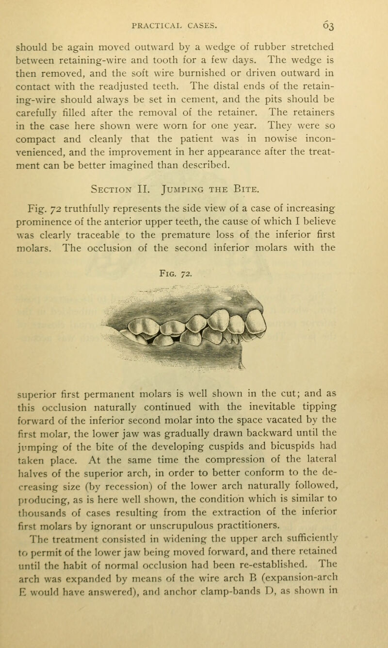 should be again moved outward by a wedge of rubber stretched between retaining-wire and tooth for a few days. The wedge is then removed, and the soft wire burnished or driven outward in contact with the readjusted teeth. The distal ends of the retain- ing-wire should always be set in cement, and the pits should be carefully tilled after the removal of the retainer. The retainers in the case here shown were worn for one year. They were so compact and cleanly that the patient was in nowise incon- venienced, and the improvement in her appearance after the treat- ment can be better imagined than described. Section II. Jumping the Bite. Fig. 72 truthfully represents the side view of a case of increasing prominence of the anterior upper teeth, the cause of which I believe was clearly traceable to the premature loss of the inferior first molars. The occlusion of the second inferior molars with the Fig. 'J2. superior first permanent molars is well shown in the cut; and as this occlusion naturally continued with the inevitable tipping forward of the inferior second molar into the space vacated by the first molar, the lower jaw was gradually drawn backward until the jumping of the bite of the developing cuspids and bicuspids had taken place. At the same time the compression of the lateral halves of the superior arch, in order to better conform to the de- (-reasing size (by recession) of the lower arch naturally followed, pioducing, as is here well shown, the condition which is similar to thousands of cases resulting from the extraction of the inferior first molars by ignorant or unscrupulous practitioners. The treatment consisted in widening the upper arch suf^cicntly to permit of the lower jaw being moved forward, and there retained until the habit of normal occlusion had been re-established. The arch was expanded by means of the wire arch B (expansion-arch R would have answered), and anchor clamp-bands D, as shown in