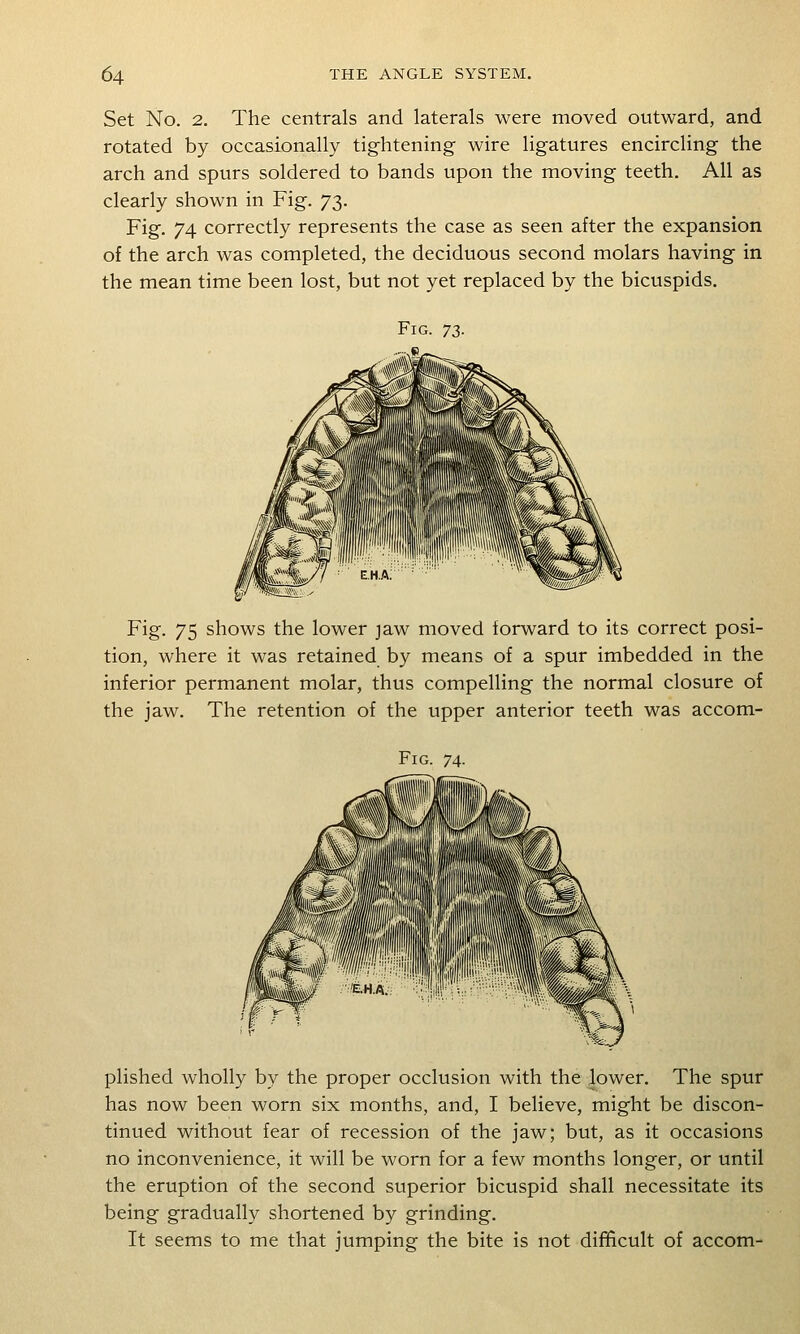 Set No. 2. The centrals and laterals were moved outward, and rotated by occasionally tig-htening wire ligatures encircling the arch and spurs soldered to bands upon the moving teeth. All as clearly shown in Fig. 73. Fig. 74 correctly represents the case as seen after the expansion of the arch was completed, the deciduous second molars having in the mean time been lost, but not yet replaced by the bicuspids. Fig. 75 shows the lower jaw moved forward to its correct posi- tion, where it was retained by means of a spur imbedded in the inferior permanent molar, thus compelling the normal closure of the jaw. The retention of the upper anterior teeth was accom- FiG. 74. plished wholly by the proper occlusion with the lower. The spur has now been worn six months, and, I believe, might be discon- tinued without fear of recession of the jaw; but, as it occasions no inconvenience, it will be worn for a few months longer, or until the eruption of the second superior bicuspid shall necessitate its being gradually shortened by grinding. It seems to me that jumping the bite is not difficult of accom-