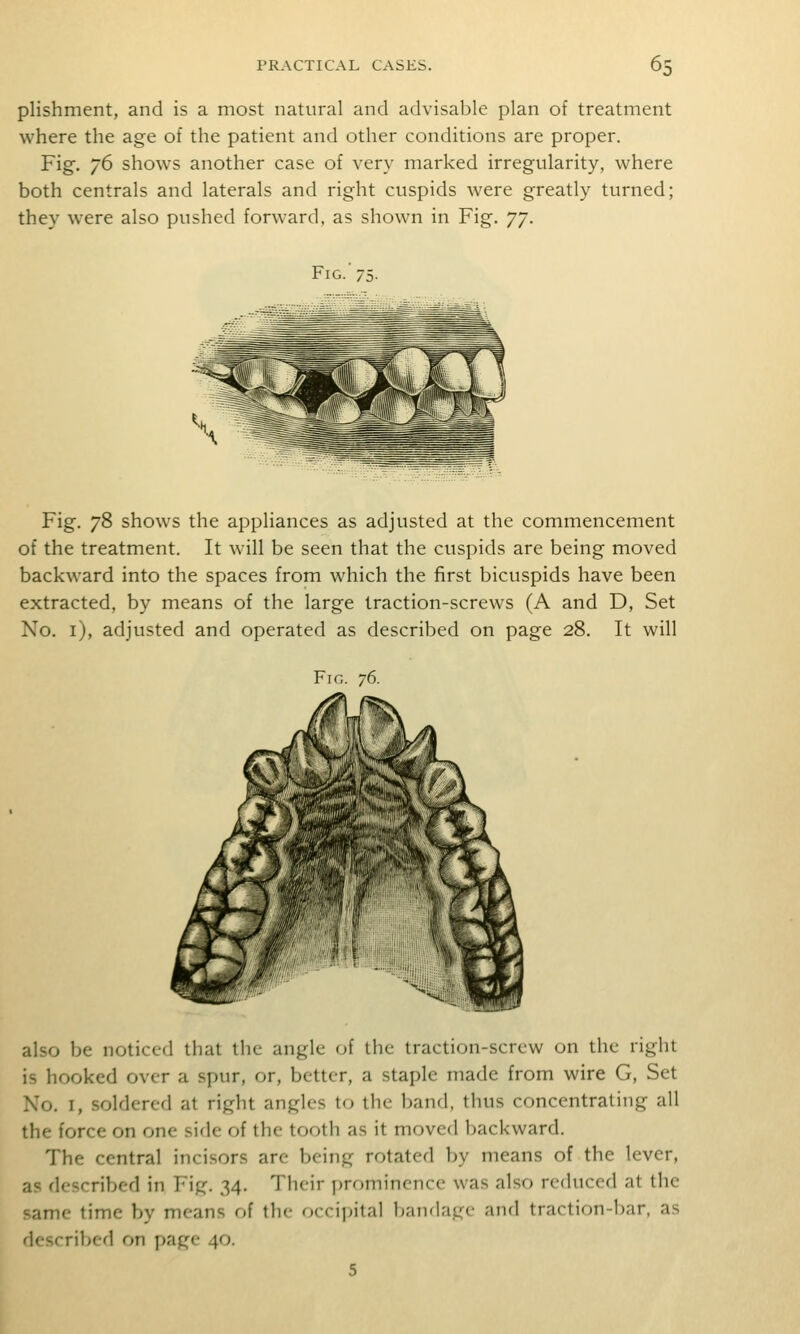 plishment, and is a most natural and advisable plan of treatment where the age of the patient and other conditions are proper. Fig. 76 shows another case of very marked irregularity, where both centrals and laterals and right cuspids were greatly turned; they were also pushed forward, as shown in Fig. jy. Fig.'75- Fig. 78 shows the appliances as adjusted at the commencement of the treatment. It will be seen that the cuspids are being moved backward into the spaces from which the first bicuspids have been extracted, by means of the large traction-screws (A and D, Set No. i), adjusted and operated as described on page 28. It will also be noticed that the angle of the traction-screw on the right is hooked over a spur, or, bettor, a staple made from wire G, Set No. I, soldered at right angles to the band, thus concentrating all the force on one sifle of the tooth as it moved l^ackward. The central incisors are being rotated by means of the lever, as described in Fig. 34. Their i)rominence was also reduced at the same time by means of the occipital bandage and traction-l)ar, as described on page 40.