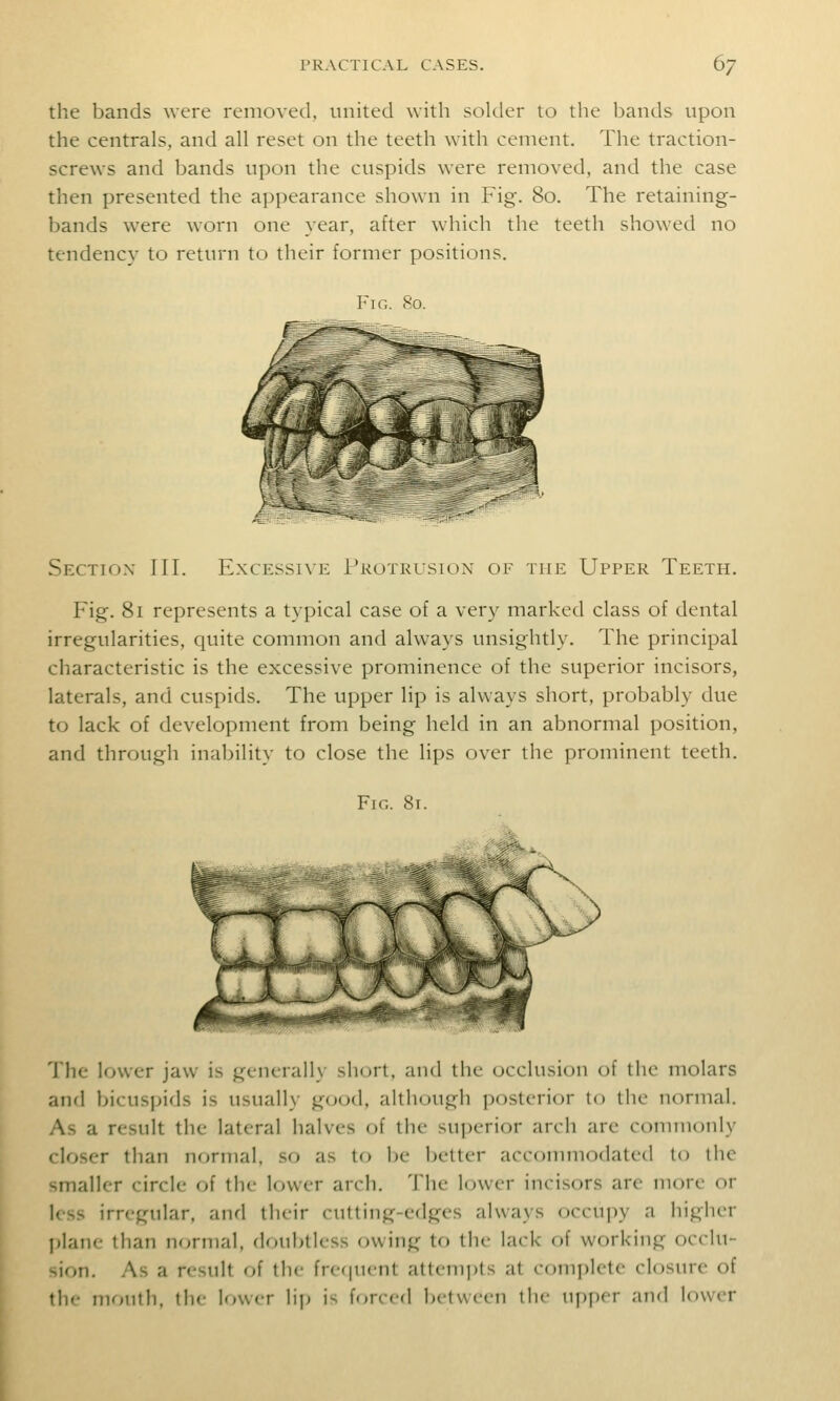 the bands were removed, united with solder to the bands upon the centrals, and all reset on the teeth with cement. The traction- screws and bands upon the cuspids were removed, and the case then presented the appearance shown in Fig. 80. The retaining- bands were worn one year, after which the teeth showed no tendency to return to their former positions. Fig. 80. Section III. Excessive I'rotrusiqx of the Upper Teeth. Fig. 81 represents a typical case of a very marked class of dental irregularities, quite common and always unsightly. The principal characteristic is the excessive prominence of the superior incisors, laterals, and cuspids. The upper lip is always short, probably due to lack of development from being held in an abnormal position, and through inability to close the lips over the prominent teeth. Fig. 81. The lower jaw is generally short, and the occlusion of the molars and bicuspids is usually g(Kjd, although posterior to the normal. As a result the lateral halves of the superior arch are commonly closer than normal, so as to be better acconmiodated to the smaller circle of the lower arch. The lower incisors are more or less irregular, and tluir cutting-edges always occupy a higher l)lane than normal, doubtless owing to the lack of working occlu- sion. As a result of the fre(|ucnt attem])ts at complete closure of the month, the lower lip is forced between the U[)|)er and lower
