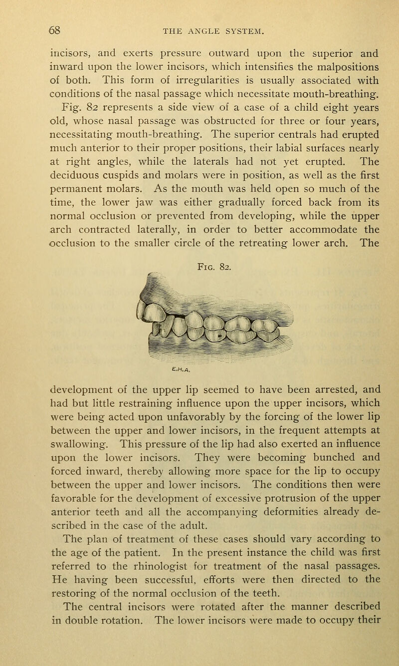 incisors, and exerts pressure outward upon the superior and inward upon the lower incisors, which intensifies the malpositions of both. This form of irregularities is usually associated with conditions of the nasal passage which necessitate mouth-breathing. Fig. 82 represents a side view of a case of a child eight years old, whose nasal passage was obstructed for three or four years, necessitating mouth-breathing. The superior centrals had erupted much anterior to their proper positions, their labial surfaces nearly at right angles, while the laterals had not yet erupted. The deciduous cuspids and molars were in position, as well as the first permanent molars. As the mouth was held open so much of the time, the lower jaw was either gradually forced back from its normal occlusion or prevented from developing, while the upper arch contracted laterally, in order to better accommodate the occlusion to the smaller circle of the retreating lower arch. The Fig. 82. development of the upper lip seemed to have been arrested, and had but little restraining influence upon the upper incisors, which were being acted upon unfavorably by the forcing of the lower lip between the upper and lower incisors, in the frequent attempts at swallowing. This pressure of the lip had also exerted an influence upon the lower incisors. They were becoming bunched and forced inward, thereby allowing more space for the lip to occupy between the upper and lower incisors. The conditions then were favorable for the development of excessive protrusion of the upper anterior teeth and all the accompanying deformities already de- scribed in the case of the adult. The plan of treatment of these cases should vary according to the age of the patient. In the present instance the child was first referred to the rhinologist for treatment of the nasal passages. He having been successful, efforts were then directed to the restoring of the normal occlusion of the teeth. The central incisors were rotated after the manner described in double rotation. The lower incisors were made to occupy their