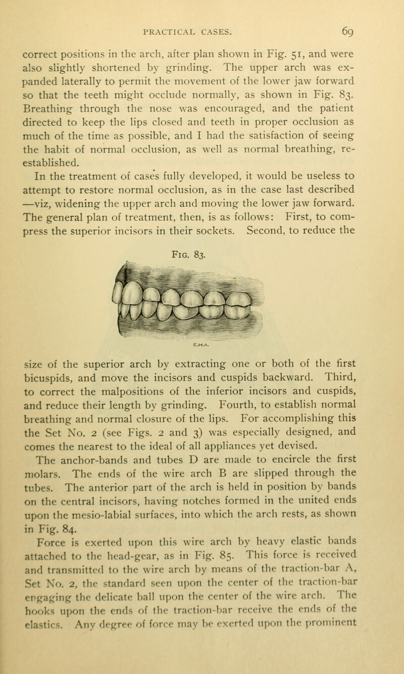 correct positions in the arch, after plan shown in Fig. 51, and were also slightly shortened by grinding. The upper arch was ex- panded laterally to permit the movement of the lower jaw forward so that the teeth might occlude normally, as shown in Fig. 83. Breathing through the nose was encouraged, and the patient directed to keep the lips closed and teeth in proper occlusion as much of the time as possible, and I had the satisfaction of seeing the habit of normal occlusion, as well as normal brealhing, re- established. In the treatment of cases fully developed, it would be useless to attempt to restore normal occlusion, as in the case last described —viz, widening the upper arch and moving the lower jaw forward. The general plan of treatment, then, is as follows: First, to com- press the superior incisors in their sockets. Second, to reduce the Fig. 83. size of the superior arch by extracting one or both of the first bicuspids, and move the incisors and cuspids backward. Third, to correct the malpositions of the inferior incisors and cuspids, and reduce their length by grinding. Fourth, to establish normal breathing and normal closure of the lips. For accomplishing this the Set No. 2 (see Figs. 2 and 3) was especially designed, and comes the nearest to the ideal of all appliances yet devised. The anchor-bands and tubes D are made to encircle the first molars. The ends of the wire arch B are slipped through the tubes. The anterior part of the arch is held in position by bands on the central incisors, having notches formed in the united ends upon the mesio-labial surfaces, into which the arch rests, as shown in Fig. 84. Force is exerted upon this wire arch by heavy elastic bands attached to the head-gear, as in Fig. 85. This force is received and transmitted to the wire arch by means of the traction-bar A, Set No. 2, the standard seen upon the center of the traction-bar engaging the delicate ball upon the center of the wire arch. The hooks upon the ends of the traction-bar receive the ends of the elastics. Any degree of force may be exerted upon tlie prominent