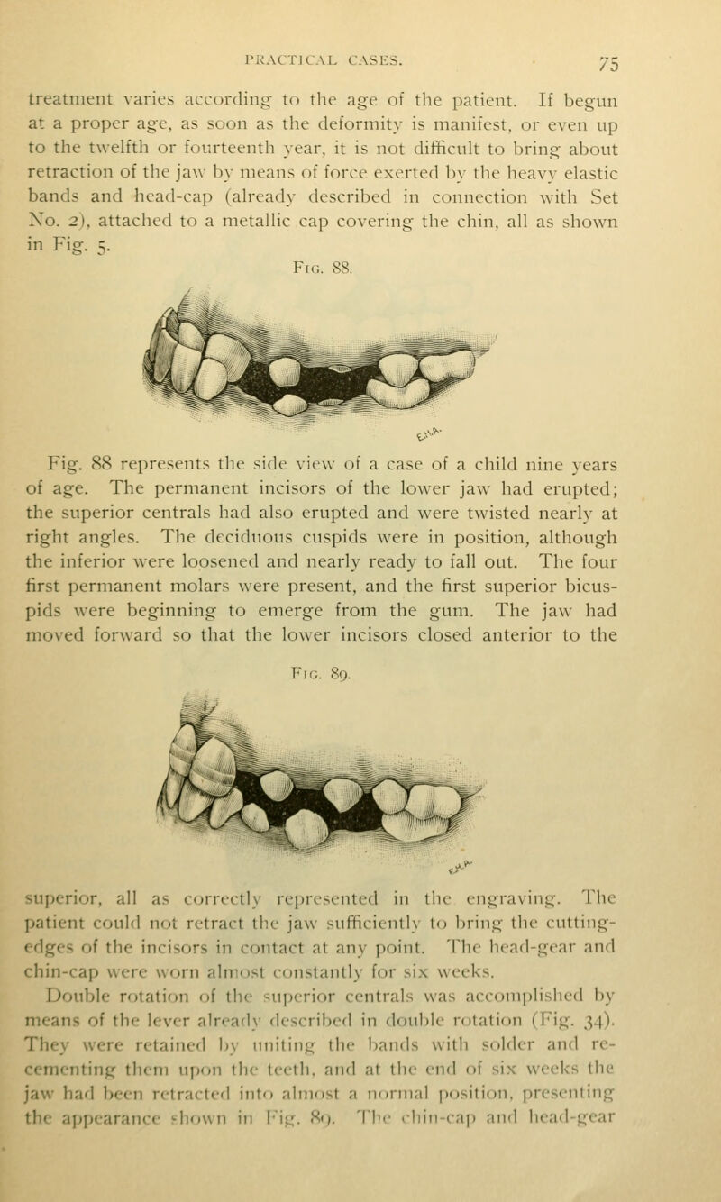 /O treatment varies according to the age of the patient. If begun at a proper age, as soon as the deformity is manifest, or even up to the twelfth or fourteenth year, it is not difficult to bring about retraction of the jaw by means of force exerted by the heavy elastic bands and head-cap (already described in connection with Set Xo. 2), attached to a metallic cap covering the chin, all as shown in Fig. 5. Fic. 88. Fig. 88 represents the side view of a case of a child nine years of age. The permanent incisors of the lower jaw had erupted; the superior centrals had also erupted and were twisted nearly at right angles. The deciduous cuspids were in position, although the inferior were loosened and nearly ready to fall out. The four first permanent molars were present, and the first superior bicus- pids were beginning to emerge from the gum. The jaw had moved forward so that the lower incisors closed anterior to the Fic. 89. superior, all as c(jrrectl\- represented in ihe engraving. The patient could not retract the jaw sufficiently lo bring the cutting- edges of the incisors in contact at any point. The head-gear and chin-cap were worn almost constantly for six weeks. Double rotatif)n oi the superior centrals was accomplished by means of the lever already described in double rotation (Fig. 34). They were retained by uniting the bands with solder and re- cementing them ujjon the teeth, and at the cu(\ of six weeks the jaw had i)een retracted into almost a normal pf)sition. presenting