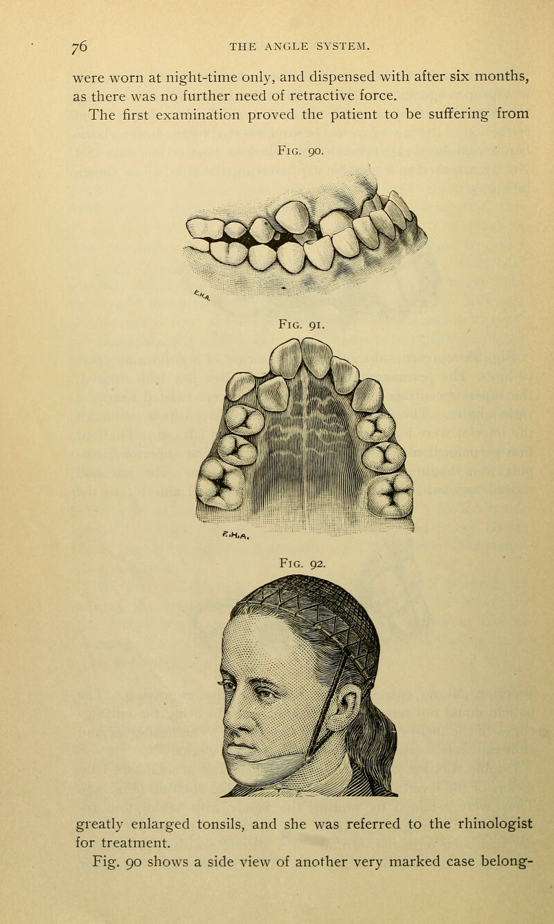 were worn at night-time only, and dispensed with after six months, as there was no further need of retractive force. The first examination proved the patient to be suffering from Fig. Fig. 91. Fig. 92. greatly enlarged tonsils, and she was referred to the rhinologist for treatment. Fig. 90 shows a side view of another very marked case belong-