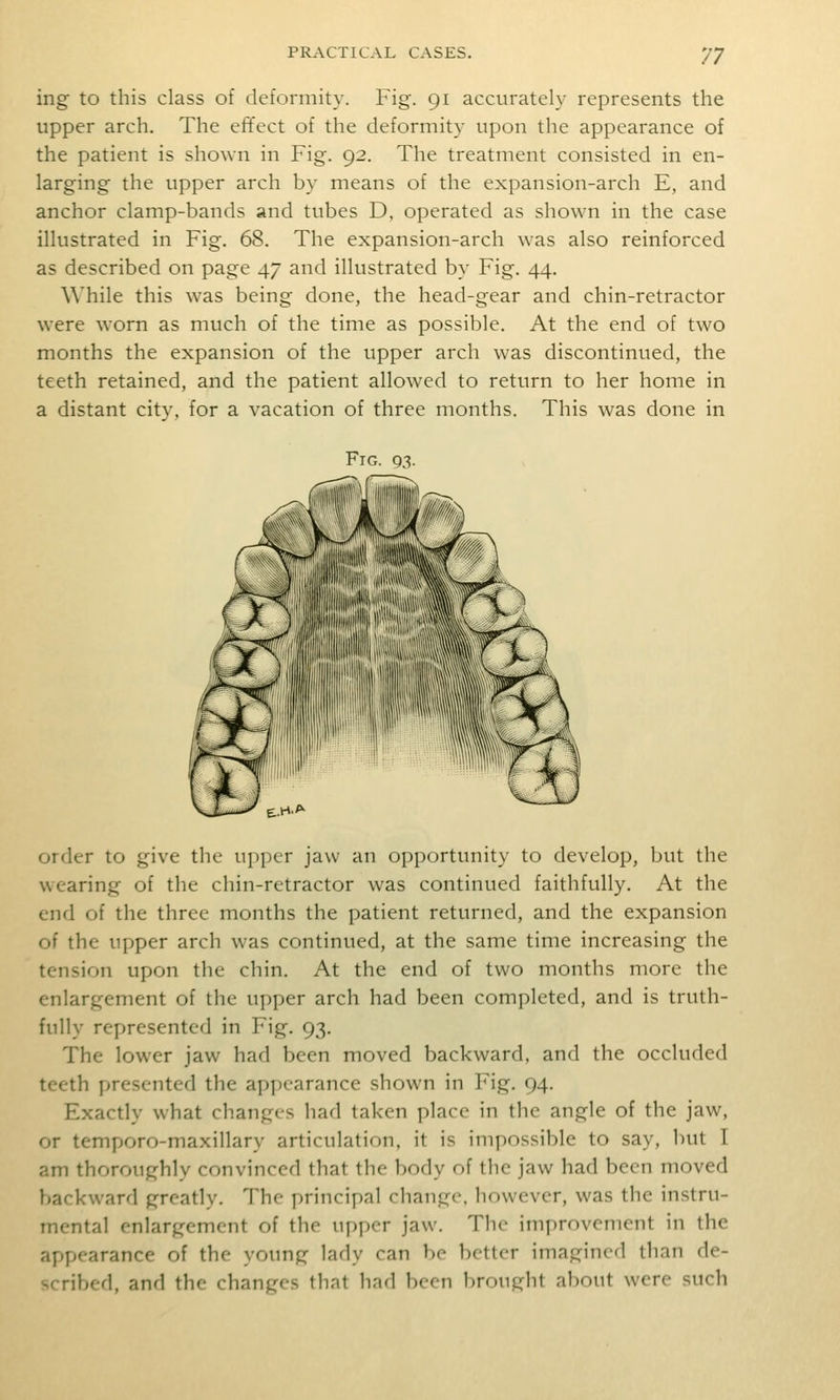 ing to this class of deformity. Fig. 91 accurately represents the upper arch. The effect of the deformity upon the appearance of the patient is shown in Fig. 92. The treatment consisted in en- larging the upper arch by means of the expansion-arch E, and anchor clamp-bands and tubes D, operated as shown in the case illustrated in Fig. 68. The expansion-arch was also reinforced as described on page 47 and illustrated by Fig. 44. \\'hile this was being done, the head-gear and chin-retractor were worn as much of the time as possible. At the end of two months the expansion of the upper arch was discontinued, the teeth retained, and the patient allowed to return to her home in a distant city, for a vacation of three months. This was done in Fig. 93. order to give the upper jaw an opportunity to develop, but the wearing of the chin-retractor was continued faithfully. At the end of the three months the patient returned, and the expansion of the upper arch was continued, at the same time increasing the tension upon the chin. At the end of two months more the enlargement of the upper arch had been completed, and is truth- fully represented in Fig. 93. The lower jaw had been moved backward, and the occluded teeth presented the appearance shown in Fig. 94. Exactly what changes had taken place in the angle of the jaw, or temporo-maxillary articulation, it is impossible to say, but I am thoroughly convinced that the body of the jaw had been moved backward greatly. The principal change, however, was the instru- mental enlargement of the upper jaw. The improvement in the appearance of the young lady can be better imagined than de- ^rribcd, and the changes that had been brought about were such