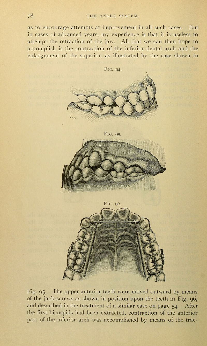 as to encourage attempts at improvement in all such cases. But in cases of advanced years, my experience is that it is useless to attempt the retraction of the jaw. All that we can then hope to accomplish is the contraction of the inferior dental arch and the enlargement of the superior, as illustrated by the case shown in Fig. 94. Fig. 95. Fig. 96. Fig. 95. The upper anterior teeth were moved outward by means of the jack-screws as shown in position upon the teeth in Fig. 96, and described in the treatment of a similar case on page 54. After the first bicuspids had been extracted, contraction of the anterior part of the inferior arch was accomplished by means of the trac-
