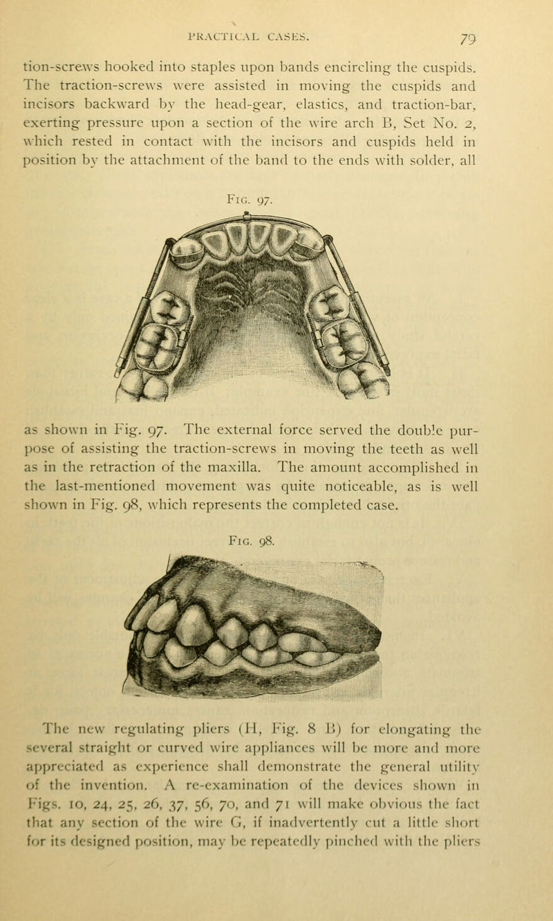 tion-screws hooked into staples upon bands encircling the cuspids. The traction-screws were assisted in moving the cuspids and incisors backward by the head-gear, elastics, and traction-bar, exerting pressure upon a section of the wire arch B, Set No. 2, which rested in contact with the incisors and cuspids held in position by the attachment of the band to the ends with solder, all Fig. 97. as shown in Fig. 97. The external force served the double pur- pose of assisting the traction-screws in moving the teeth as well as in the retraction of the maxilla. The amount accomplished in the last-mentioned movement was cjuite noticeable, as is well shown in Fig. 98, wliich represents the completed case. Fig. 98. The new regulating pliers (H, Fig. 8 I>) for elongating the several straight or curved wire appliances will be more and more appreciated as experience shall demonstrate the general utility of the invention. A re-examination of the devices shown in l-igs. 10, 24, 25, 26, 37, 56, 70, and 71 will make obvious the fact that any section of the wire G, if inadvertently cut a little short for its designed position, may be repeatedly pinched with the pliers