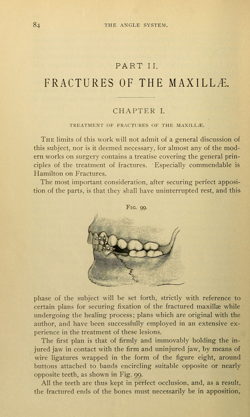 PART II. FRACTURES OF THE MAXILLA. CHAPTER I. TREATMENT OF FRACTl'RES OF THE MAXILLA. The limits of this work will not admit of a general discussion of this subject, nor is it deemed necessary, for almost any of the mod- ern works on surgery contains a treatise covering the general prin- ciples of the treatment of fractures. Especially commendable is Hamilton on Fractures. The most important consideration, after securing perfect apposi- tion of the parts, is that they shall have uninterrupted rest, and this Fig. 99. phase of the subject will be set forth, strictly with reference to certain plans for securing fixation of the fractured maxillae while undergoing the healing process; plans which are original with the author, and have been successfully employed in an extensive ex- perience in the treatment of these lesions. The first plan is that of firmly and immovably holding the in- jured jaw in contact with the firm and uninjured jaw, by means of wire ligatures wrapped in the form of the figure eight, around buttons attached to bands encircling suitable opposite or nearly opposite teeth, as shown in Fig. 99. All the teeth are thus kept in perfect occlusion, and, as a result, the fractured ends of the bones must necessarily be in apposition,