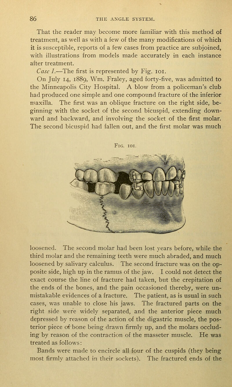 That the reader may become more famihar with this method of treatment, as well as with a few of the many modifications of which it is susceptible, reports of a few cases from practice are subjoined, with illustrations from models made accurately in each instance after treatment. Case I.—The first is represented by Fig. loi. On July 14, 1889, Wm. Fraley, aged forty-five, was admitted to the Minneapolis City Hospital. A blow from a policeman's club had produced one simple and one compound fracture of the inferior maxilla. The first was an oblique fracture on the right side, be- ginning with the socket of the second bicuspid, extending down- ward and backward, and involving the socket of the first molar. The second bicuspid had fallen out, and the first molar was much Fig. ioi. loosened. The second molar had been lost years before, while the third molar and the remaining teeth were much abraded, and much loosened by salivary calculus. The second fracture was on the op- posite side, high up in the ramus of the jaw. I could not detect the exact course the line of fracture had taken, but the crepitation of the ends of the bones, and the pain occasioned thereby, were un- mistakable evidences of a fracture. The patient, as is usual in such cases, was unable to close his jaws. The fractured parts on the right side were widely separated, and the anterior piece much depressed by reason of the action of the digastric muscle, the pos- terior piece of'bone being drawn firmly up, and the molars occlud- ing by reason of the contraction of the masseter muscle. He was treated as follows: Bands were made to encircle all four of the cuspids (they being most firmly attached in their sockets). The fractured ends of the