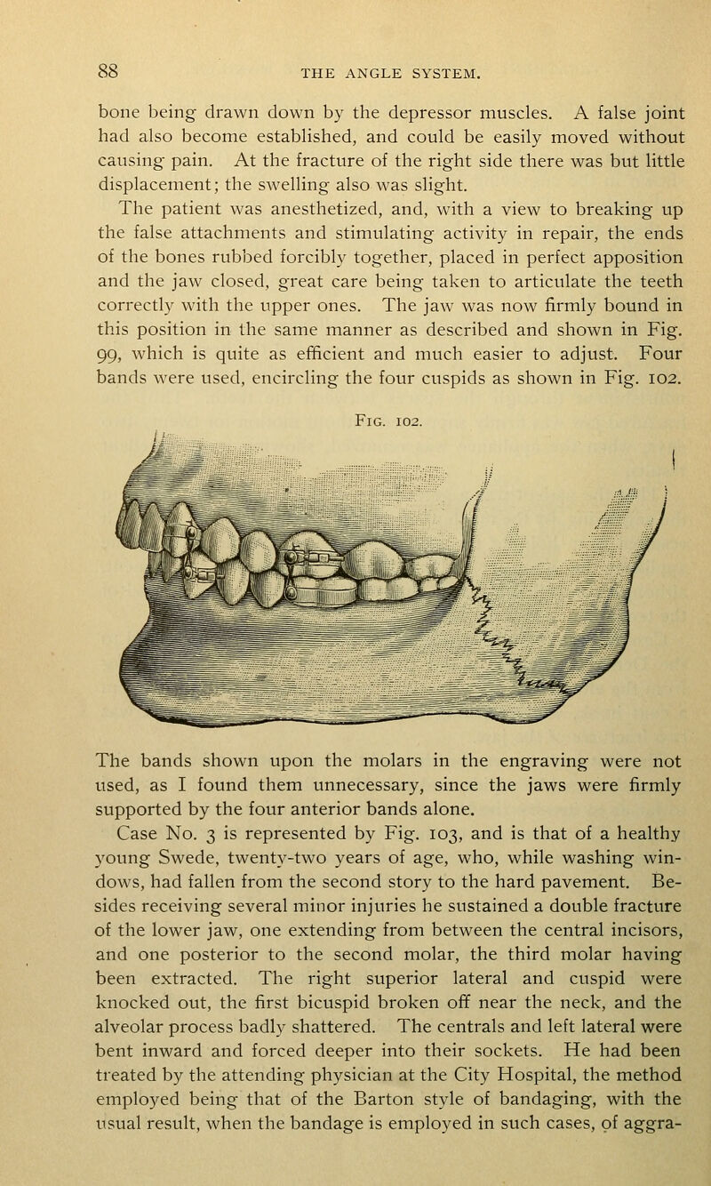 bone being drawn down by the depressor muscles. A false joint had also become established, and could be easily moved without causing pain. At the fracture of the right side there was but little displacement; the swelling also was slight. The patient was anesthetized, and, with a view to breaking up the false attachments and stimulating activity in repair, the ends of the bones rubbed forcibly together, placed in perfect apposition and the jaw closed, great care being taken to articulate the teeth correctly with the upper ones. The jaw was now firmly bound in this position in the same manner as described and shown in Fig, 99, which is quite as efficient and much easier to adjust. Four bands were used, encircling the four cuspids as shown in Fig. 102, Fig. 102. The bands shown upon the molars in the engraving were not used, as I found them unnecessary, since the jaws were firmly supported by the four anterior bands alone. Case No. 3 is represented by Fig. 103, and is that of a healthy young Swede, twenty-two years of age, who, while washing win- dows, had fallen from the second story to the hard pavement. Be- sides receiving several minor injuries he sustained a double fracture of the lower jaw, one extending from between the central incisors, and one posterior to the second molar, the third molar having been extracted. The right superior lateral and cuspid were knocked out, the first bicuspid broken off near the neck, and the alveolar process badly shattered. The centrals and left lateral were bent inward and forced deeper into their sockets. He had been treated by the attending physician at the City Hospital, the method employed being that of the Barton style of bandaging, with the usual result, when the bandage is employed in such cases, of aggra-