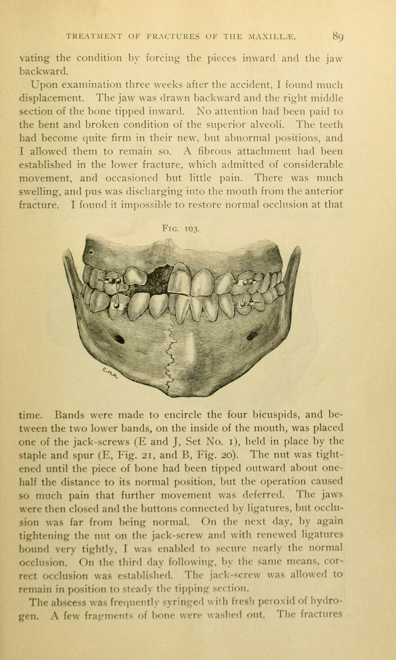 \'ating the condition b\- forcing the pieces inward and the jaw backward. Upon examination three weeks after the accident. I found nuicli displacement. The jaw was drawn backward and the right middle section of the bone tipped inward. No attention had been paid to the bent and broken condition of the superior alveoH. The teeth had become quite firm in their new, but abnormal positions, and I allowed them to remain so. A fibrous attachment had been established in the lower fracture, which admitted of considerable movement, and occasioned but little pain. There was much sw-elling, and pus was discharging into the mouth from the anterior fracture. I found it impossible to restore normal occlusion at that Fig. 103. time. Bands were made to encircle the four bicuspids, and be- tween the two lower bands, on the inside of the mouth, was placed one of the jack-screws (E and J, Set No. i), held in place by the staple and spur (E, Fig. 21, and B, Fig. 20). The nut was tight- ened until the piece of bone had been tipped outward about one- half the distance to its normal position, but the operation caused so much pain that further movement was flcferred. The jaws were then closed and the buttons connected by ligatures, but occlu- sion was far from being normal. On the next day, by again tightening the nut on the jack-screw and with renewed ligatures bound very tightly, I was enabled to secure nearly the normal occlusion. On the third day following, by the same means, cor- rect occlusion was established. The jack-screw was allowed to remain in position to steady the tipj^ing section. The abscess was frequently syringed with fresh peroxid of hydro- gen, A few fragments of bone were washed out. The fractures