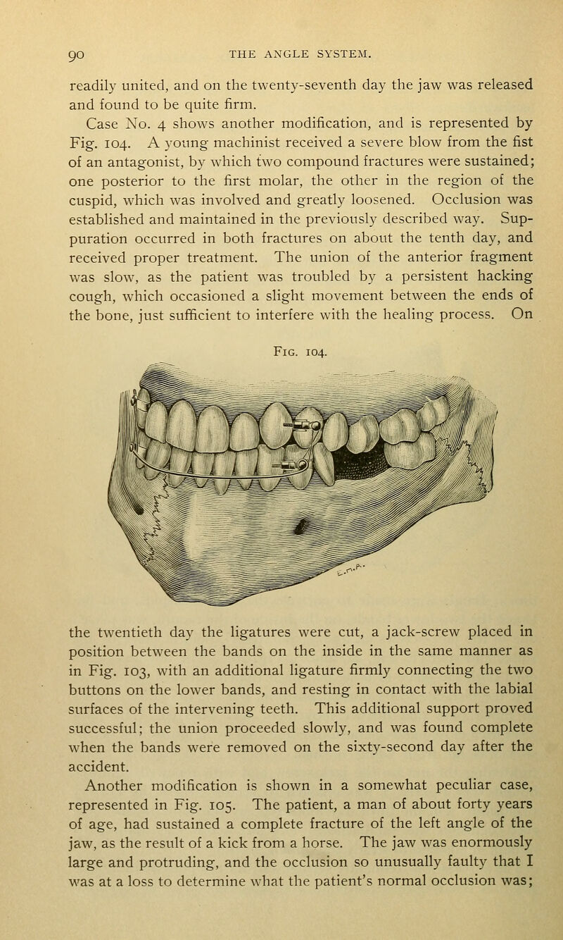 readily united, and on the twenty-seventh day the jaw was released and found to be quite firm. Case No. 4 shows another modification, and is represented by Fig. 104. A young machinist received a severe blow from the fist of an antagonist, by which two compound fractures were sustained; one posterior to the first molar, the other in the region of the cuspid, which was involved and greatly loosened. Occlusion was established and maintained in the previously described way. Sup- puration occurred in both fractures on about the tenth day, and received proper treatment. The union of the anterior fragment was slow, as the patient was troubled by a persistent hacking cough, which occasioned a slight movement between the ends of the bone, just sufficient to interfere with the healing process. On Fig. 104. the twentieth day the ligatures were cut, a jack-screw placed in position between the bands on the inside in the same manner as in Fig. 103, with an additional ligature firmly connecting the two buttons on the lower bands, and resting in contact with the labial surfaces of the intervening teeth. This additional support proved successful; the union proceeded slowly, and was found complete when the bands were removed on the sixty-second day after the accident. Another modification is shown in a somewhat peculiar case, represented in Fig. 105. The patient, a man of about forty years of age, had sustained a complete fracture of the left angle of the jaw, as the result of a kick from a horse. The jaw was enormously large and protruding, and the occlusion so unusually faulty that I was at a loss to determine what the patient's normal occlusion was;
