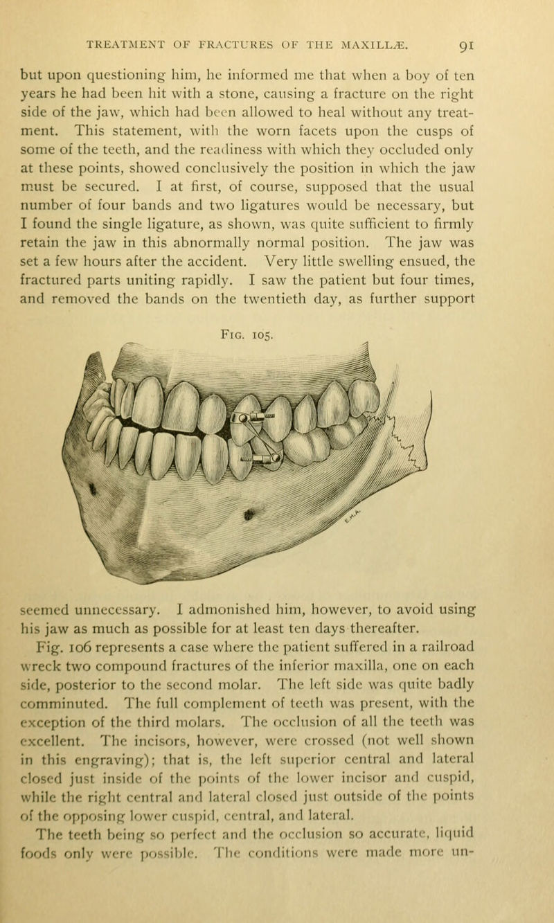 but upon questioning him, he informed me that when a boy of ten years he had been hit with a stone, causing a fracture on the right side of the jaw, which had been allowed to heal without any treat- ment. This statement, with the worn facets upon the cusps of some of the teeth, and the readiness with which they occluded only at these points, showed conclusively the position in which the jaw niust be secured. I at first, of course, supposed that the usual number of four bands and two ligatures would be necessary, but I found the single ligature, as shown, was quite sufficient to firmly retain the jaw in this abnormally normal position. The jaw was set a few hours after the accident. Very little swelling ensued, the fractured parts uniting rapidly. I saw the patient but four times, and removed the bands on the twentieth day, as further support Fig. 105. seemed unnecessary. 1 admonished him, however, to avoid using his jaw as much as possible for at least ten days thereafter. Fig. 106 represents a case where the patient suffered in a railroad wreck two compound fractures of the inferior maxilla, one on each side, posterior to the second molar. The left side was quite badly comminuted. The full complement of teeth was present, with the exception of the third molars. The occlusion of all the teeth was excellent. The incisors, however, were crossed (not well shown in this engraving); that is, the left superior central and lateral closed just inside of the points of the lower incisor and cuspid, while the right central and lateral closed just outside of the points of the opposing lower cuspifl, central, and lateral. The teeth being so perfect and the occlusion so accurate, liquid U)f)(h only were pfjssiblc TIk- iDiiditioiis were made mr)r<' un-