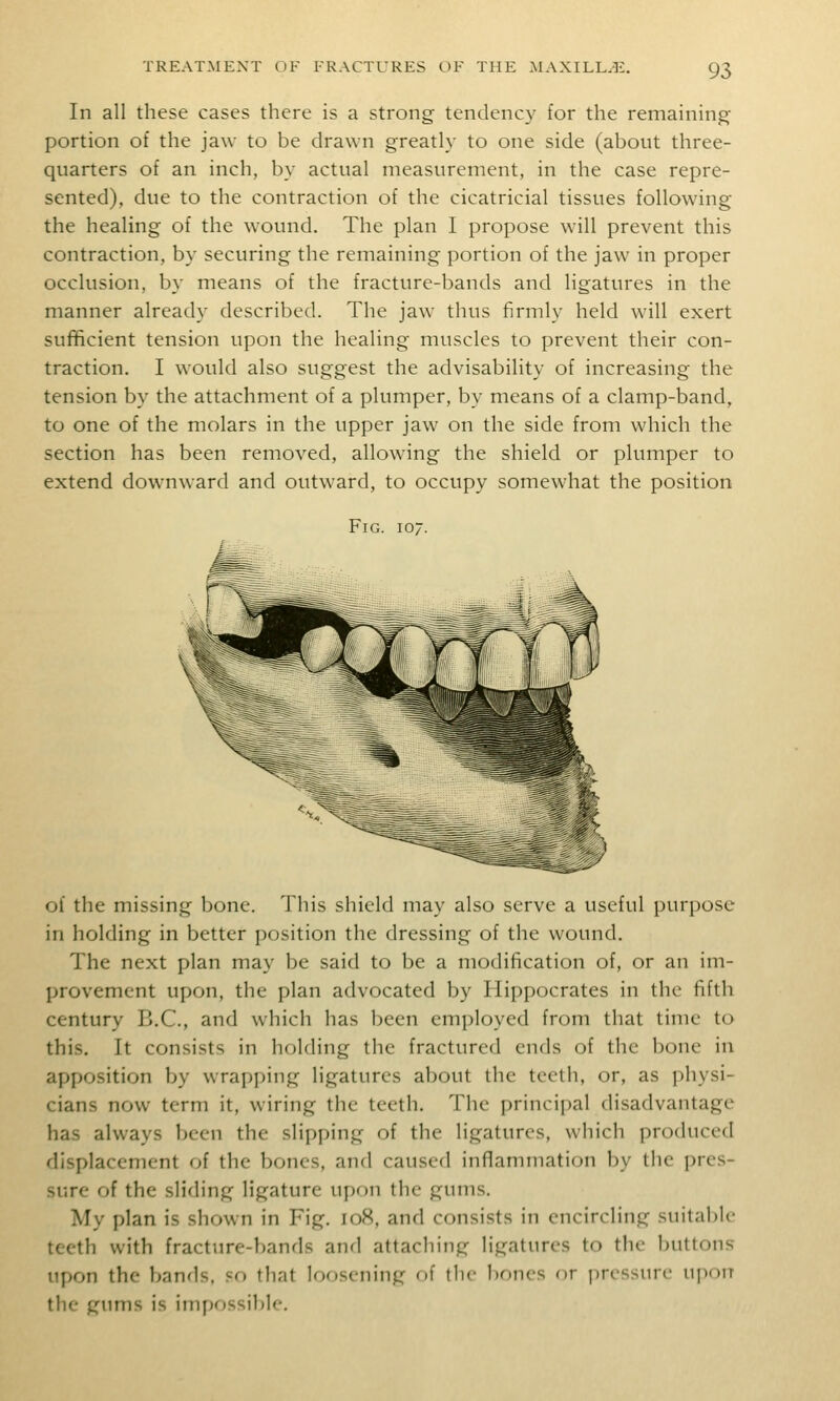 In all these cases there is a strong tendency for the remaining portion of the jaw to be drawn greatly to one side (about three- quarters of an inch, by actual measurement, in the case repre- sented), due to the contraction of the cicatricial tissues following the healing of the wound. The plan I propose will prevent this contraction, by securing the remaining portion of the jaw in proper occlusion, by means of the fracture-bands and ligatures in the manner already described. The jaw thus firmly held will exert sufficient tension upon the healing muscles to prevent their con- traction. I would also suggest the advisability of increasing the tension by the attachment of a plumper, by means of a clamp-band, to one of the molars in the upper jaw on the side from which the section has been removed, allowing the shield or plumper to extend downward and outward, to occupy somewhat the position Fig. 107. of the missing bone. This shield may also serve a useful purpose in holding in better position the dressing of the wound. The next plan may be said to be a modification of, or an im- provement upon, the plan advocated by Hippocrates in the fifth century B.C., and which has been employed from that time to this. It consists in holding the fractured ends of the bone in apposition by wrapping ligatures about the teeth, or, as physi- cians now term it, wiring the teeth. The principal disadvantage has always been the slipping of the ligatures, which produced displacement of the bones, and caused inflammation by the pres- sure of the sliding ligature upon the gums. My plan is shown in Fig. 108, and consists in encircling suitable teeth with fracture-bands and attaching ligatures to the buttons upon the bands, so that loosening of tlic !)ones or pressure upon the gums is impossible.