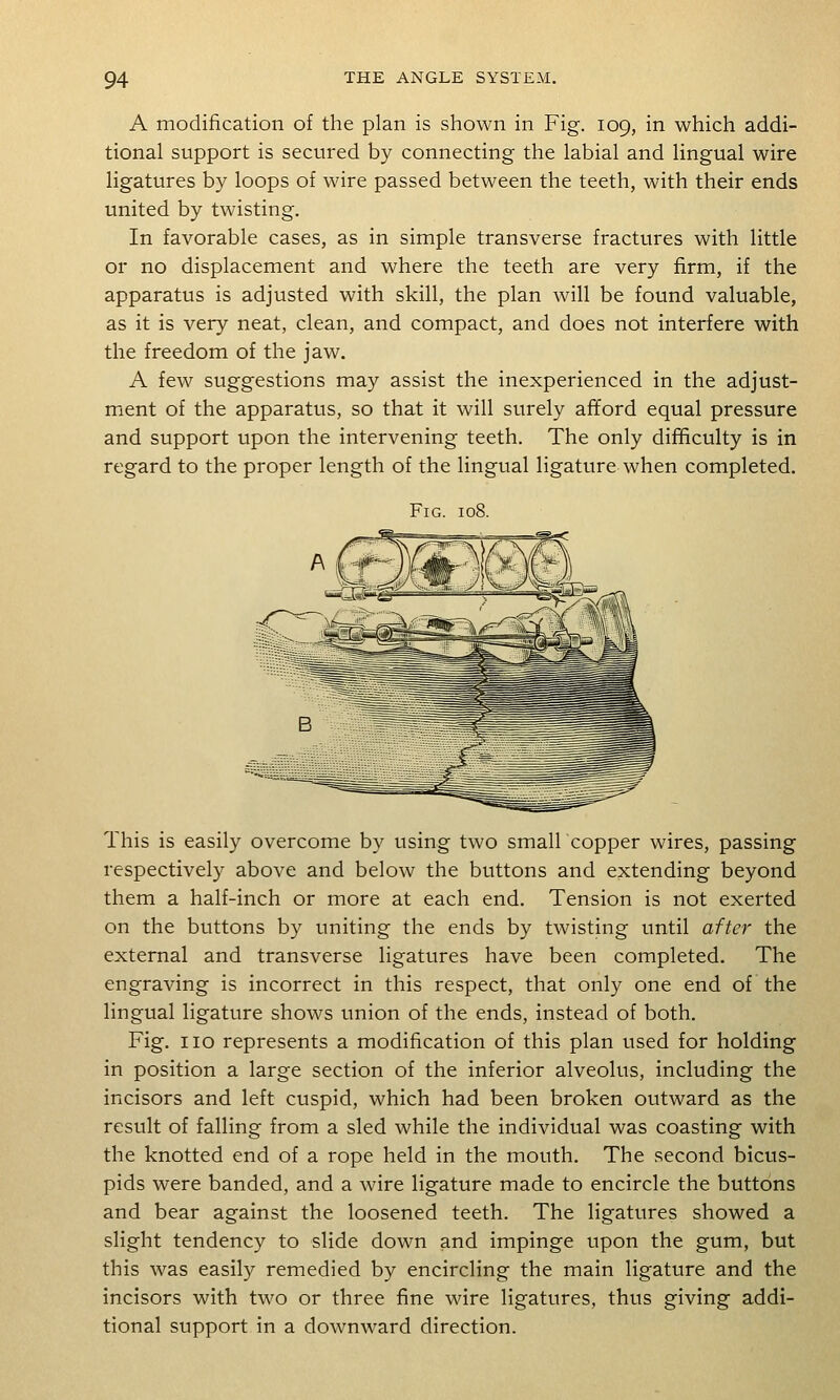 A modification of the plan is shown in Fig. 109, in which addi- tional support is secured by connecting the labial and lingual wire ligatures by loops of wire passed between the teeth, with their ends united by twisting. In favorable cases, as in simple transverse fractures with little or no displacement and where the teeth are very firm, if the apparatus is adjusted with skill, the plan will be found valuable, as it is very neat, clean, and compact, and does not interfere with the freedom of the jaw. A few suggestions may assist the inexperienced in the adjust- mient of the apparatus, so that it will surely afford equal pressure and support upon the intervening teeth. The only difBculty is in regard to the proper length of the lingual ligature when completed. Fig. 108. This is easily overcome by using two small copper wires, passing respectively above and below the buttons and extending beyond them a half-inch or more at each end. Tension is not exerted on the buttons by uniting the ends by twisting until after the external and transverse ligatures have been completed. The engraving is incorrect in this respect, that only one end of the lingual ligature shows imion of the ends, instead of both. Fig. no represents a modification of this plan used for holding in position a large section of the inferior alveolus, including the incisors and left cuspid, which had been broken outward as the result of falling from a sled while the individual was coasting with the knotted end of a rope held in the mouth. The second bicus- pids were banded, and a wire ligature made to encircle the buttons and bear against the loosened teeth. The ligatures showed a slight tendency to slide down and impinge upon the gum, but this was easily remedied by encircling the main ligature and the incisors with two or three fine wire ligatures, thus giving addi- tional support in a downward direction.