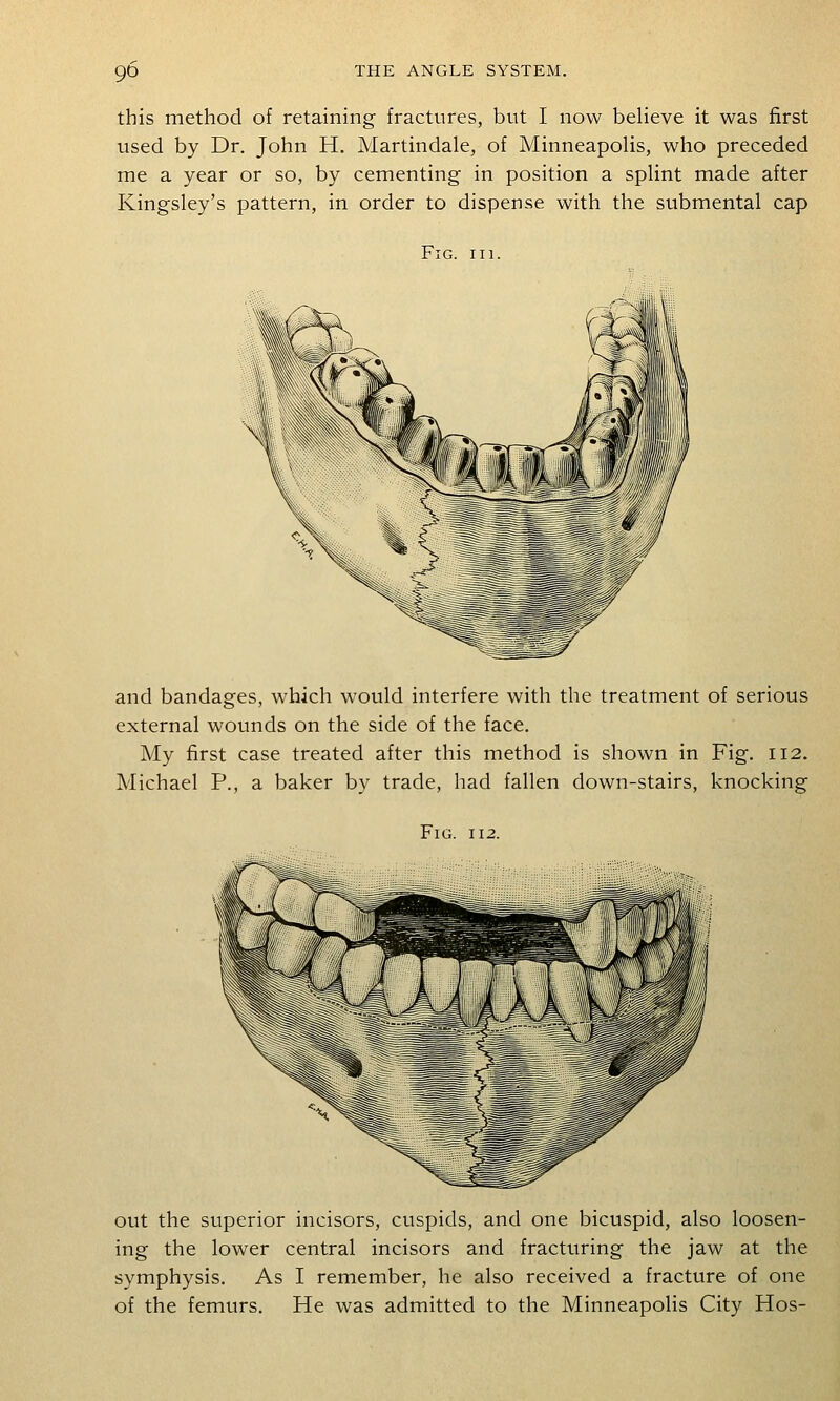 this method of retaining fractures, but I now believe it was first used by Dr. John H. Martindale, of Minneapolis, who preceded me a year or so, by cementing in position a splint made after Kingsley's pattern, in order to dispense with the submental cap Fig. III. and bandages, which would interfere with the treatment of serious external wounds on the side of the face. My first case treated after this method is shown in Fig. 112. Michael P., a baker by trade, had fallen down-stairs, knocking Fig. 112. out the superior incisors, cuspids, and one bicuspid, also loosen- ing the lower central incisors and fracturing the jaw at the symphysis. As I remember, he also received a fracture of one of the femurs. He was admitted to the Minneapolis City Hos-