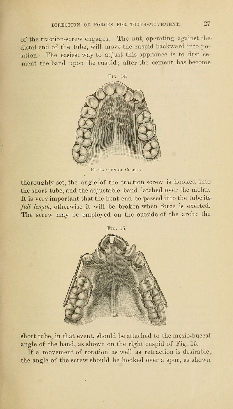 of the traction-screw engages. The nut, operating against the distal end of the tube, will move the cuspid backward into po- sition.- The easiest way to adjust this appliance is to first ce- ment the band upon the cuspid; after the cement has become Retraction of Cuspid. thoroughly set, the angle of the traction-screw is hooked into- the short tube, and the adjustable band latched over the molar. It is very important that the bent end be passed into the tube its full length, otherwise it will be broken when force is exerted. The screw may be employed on the outside of the arch; the Fig. 15. short tube, in that event, should be attached to the mesio-buccal angle of the band, as shown on the right cuspid of Fig. 15. If a movement of rotation as well as retraction is desirable, the angle of the screw should be hooked over a spur, as shown