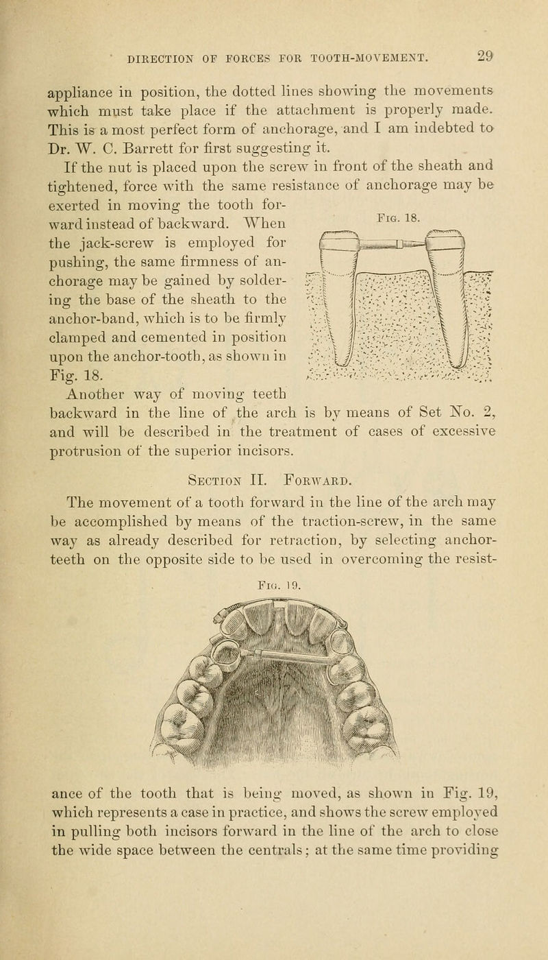 Fig. 18. appliance in position, the dotted lines showing the movements which must take place if the attachment is properly made. This is a most perfect form of anchorage, and I am indebted to Dr. W. C. Barrett for first suggesting it. If the nut is placed upon the screw in front of the sheath and tightened, force with the same resistance of anchorage may be exerted in moving the tooth for- ward instead of backward. AVhen the jack-screw is employed for pushing, the same firmness of an- chorage may be gained by solder- ing the base of the sheath to the anchor-band, which is to be firmly clamped and cemented in position upon the anchor-tooth, as shown in Fig. 18. Another way of moving teeth backward in the line of the arch is b}^ means of Set 'No. 2, and will be described in the treatment of cases of excessive protrusion of the superior incisors. Section II. Forward. The movement of a tooth forward in the line of the arch may be accomplished by means of the traction-screw, in the same way as already described for retraction, by selecting anchor- teeth on the opposite side to be used in overcoming the resist- Fio. 19. ance of the tooth that is being moved, as shown in Fig. 19, which represents a case in practice, and shows the screw employed in pulling both incisors forward in the line of the arch to close the wide space between the centrals; at the same time providing