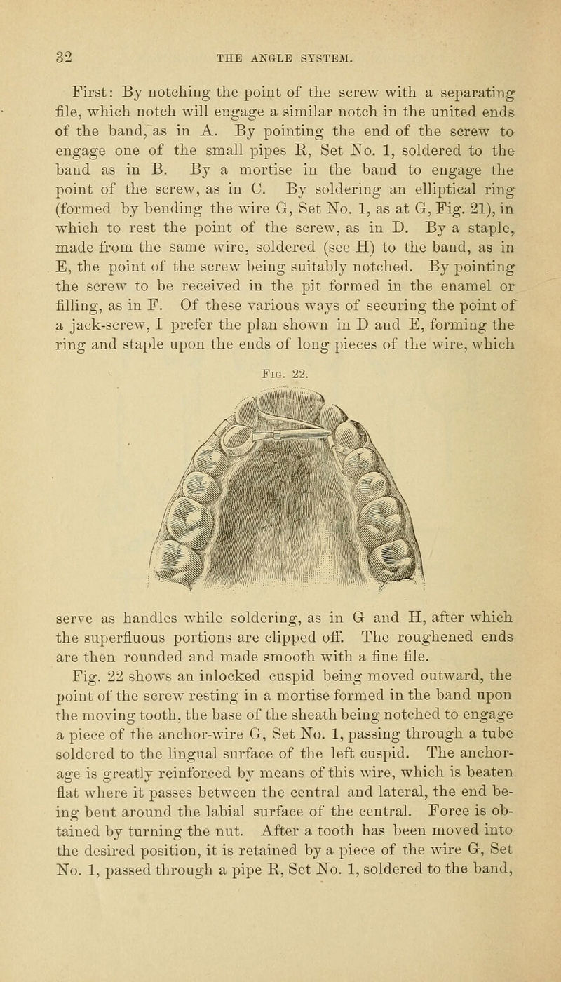 First: By notcliing the point of the screw with a separating- file, which notch will engage a similar notch in the united ends of the band, as in A. By pointing the end of the screw to engage one of the small pipes R, Set 'No. 1, soldered to the band as in B. By a mortise in the band to engage the point of the screw, as in C. By soldering an elliptical ring (formed by bending the wire G, Set ISTo. 1, as at G, Fig. 21), in which to rest the point of the screw, as in D. By a staple, made from the same wire, soldered (see H) to the band, as in E, the point of the screw being suitably notched. By pointing the screw to be received in the pit formed in the enamel or filling, as in F. Of these various ways of securing the point of a jack-screw, I prefer the plan shown in D and E, forming the ring and staple upon the ends of long pieces of the wire, which Fig. 22. serve as handles while soldering, as in G and H, after which the superfluous portions are clipped off. The roughened ends are then rounded and made smooth with a fine file. Fig. 22 shows an in locked cuspid being moved outward, the point of the screw resting in a mortise formed in the band upon the moving tooth, the base of the sheath being notched to engage a piece of the anchor-wire G, Set No. 1, passing through a tube soldered to the lingual surface of the left cuspid. The anchor- age is greatly reinforced by means of this wire, which is beaten flat where it passes between the central and lateral, the end be- ins: bent around the labial surface of the central. Force is ob- tained by turning the nut. After a tooth has been moved into the desired position, it is retained by a piece of the wire G, Set No. 1, passed through a pipe R, Set No. 1, soldered to the band,