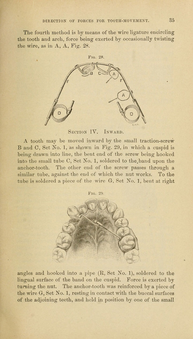 The fourth method is by means of th« wire ligature encircling the tooth and arch, force being exerted by occasionally twisting the wire, as in A, A, Fis;. 28. Fig. 28. Section IV. Inward. A tooth may be moved inward by the small traction-screw B and C, Set No. 1, as shown in Fig. 29, in which a cuspid is being drawn into line, the bent end of the screw being hooked into the small tube C, Set No. 1, soldered to the,band upon the anchor-tooth. The other end of the screw passes through a similar tube, against the end of which the nut works. To the tube is soldered a piece of the wire G, Set No. 1, bent at right Fig. 29. .;<SS!p!i^...... angles and hooked into a pipe (R, Set No. 1), soldered to the lingual surface of the band on the cuspid. Force is exerted by turning the nut. The anchor-tooth was reinforced by a piece of the wire G, Set No. 1, resting in contact with the buccal surfaces of the adjoining teeth, and held in position by one of the small