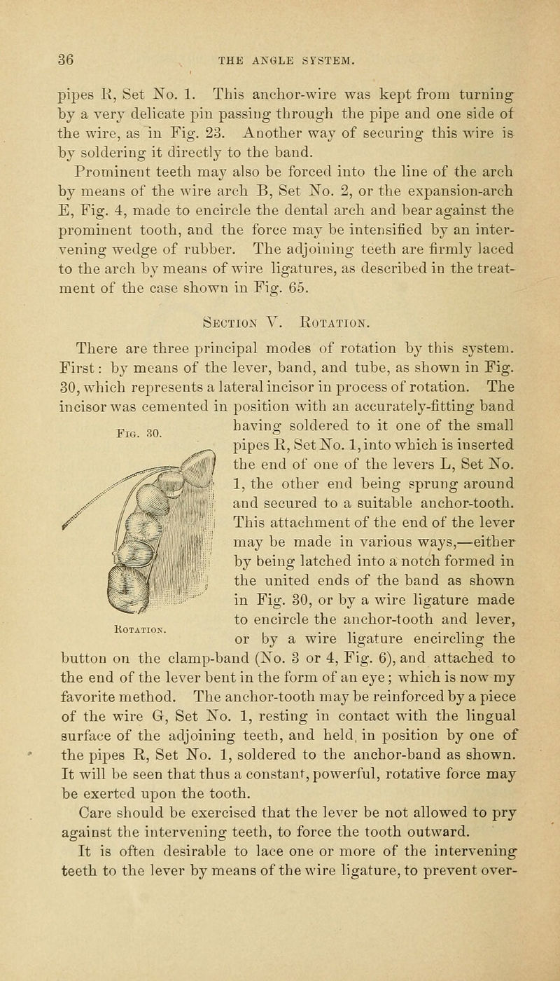 pipes K, Set No. 1. This anchor-wire was kept from turning- by a very delicate pin passing through the pipe and one side of the wire, as in Fig. 23. Another way of securing this wire is by soldering it directly to the hand. Prominent teeth ma}' also be forced into the line of the arch by means of the wire arch B, Set No. 2, or the expansion-arch E, Fig. 4, made to encircle the dental arch and bear against the prominent tooth, and the force may be intensified by an inter- vening wedge of rubber. The adjoining teeth are firmly laced to the arch by mieans of wire ligatures, as described in the treat- ment of the case shown in Fig. 65. Section Y. Rotation. There are three principal modes of rotation by this system. First: by means of the lever, band, and tube, as shown in Fig. 30, which represents a lateral incisor in process of rotation. The incisor was cemented in position with an accurately-fitting band -^ „„ bavino; soldered to it one of the small Fig. 30. '=' . , pipes R, Set No. l,into which is inserted the end of one of the levers L, Set No. 1, the other end being sprung around and secured to a suitable anchor-tooth. This attachment of the end of the lever may be made in various ways,—either by being latched into a: notch formed in the united ends of the band as shown in Fig. 30, or by a wire ligature made to encircle the anchor-tooth and lever, or by a wire ligature encircling the button on the clamp-band (No. 3 or 4, Fig. 6), and attached to the end of the lever bent in the form of an eye; which is now my favorite method. The anchor-tooth may be reinforced by a piece of the wire G, Set No. 1, resting in contact with the lingual surface of the adjoining teeth, and held, in position by one of the pipes R, Set No. 1, soldered to the anchor-band as shown. It will be seen that thus a constant, powerful, rotative force may be exerted upon the tooth. Care should be exercised that the lever be not allowed to pry against the intervening teeth, to force the tooth outward. It is often desirable to lace one or more of the intervening- teeth to the lever by means of the wire ligature, to prevent over-