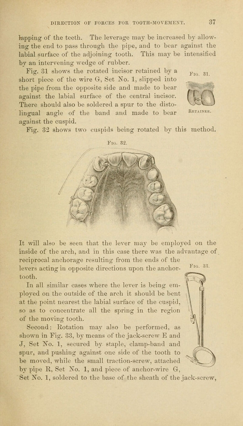 Fig. 31. lapping of the teeth. The leverage may be increased by allow- ing the end to pass through the pipe, and to bear against the labial surface of the adjoining tooth. This may be intensified by an intervening wedge of rubber. Fig. 31 shows the rotated incisor retained by a short piece of the wire G, Set No. 1, slipped into the pipe from the opposite side and made to bear asainst the labial surface of the central incisor. There should also be soldered a spur to the disto- lingual angle of the band and made to bear against the cuspid. Fig. 32 shows two cuspids being rotated by this method. Fig. 32. Retainer. It will also be seen that the lever may be employed on the inside of the arch, and in this case there was the advantage of reciprocal anchorage resulting from the ends of the levers acting in opposite directions upon the anchor- tooth. In all similar cases where the lever is being em- ployed on the outside of the arch it should be bent at the point nearest the labial surface of the cuspid, so as to concentrate all the spring in the region of the moving tooth. Second: Rotation ma}' also be performed, as shown in Fig. 33, by means of the jack-screw E and J, Set E©. 1, secured by staple, clamp-band and spur, and pushing against one side of the tooth to be moved, while the small traction-screw, attached by pipe R, Set No. 1, and piece of anchor-wire G, Set No. 1, soldered to the base of the sheath of the jack-screw,