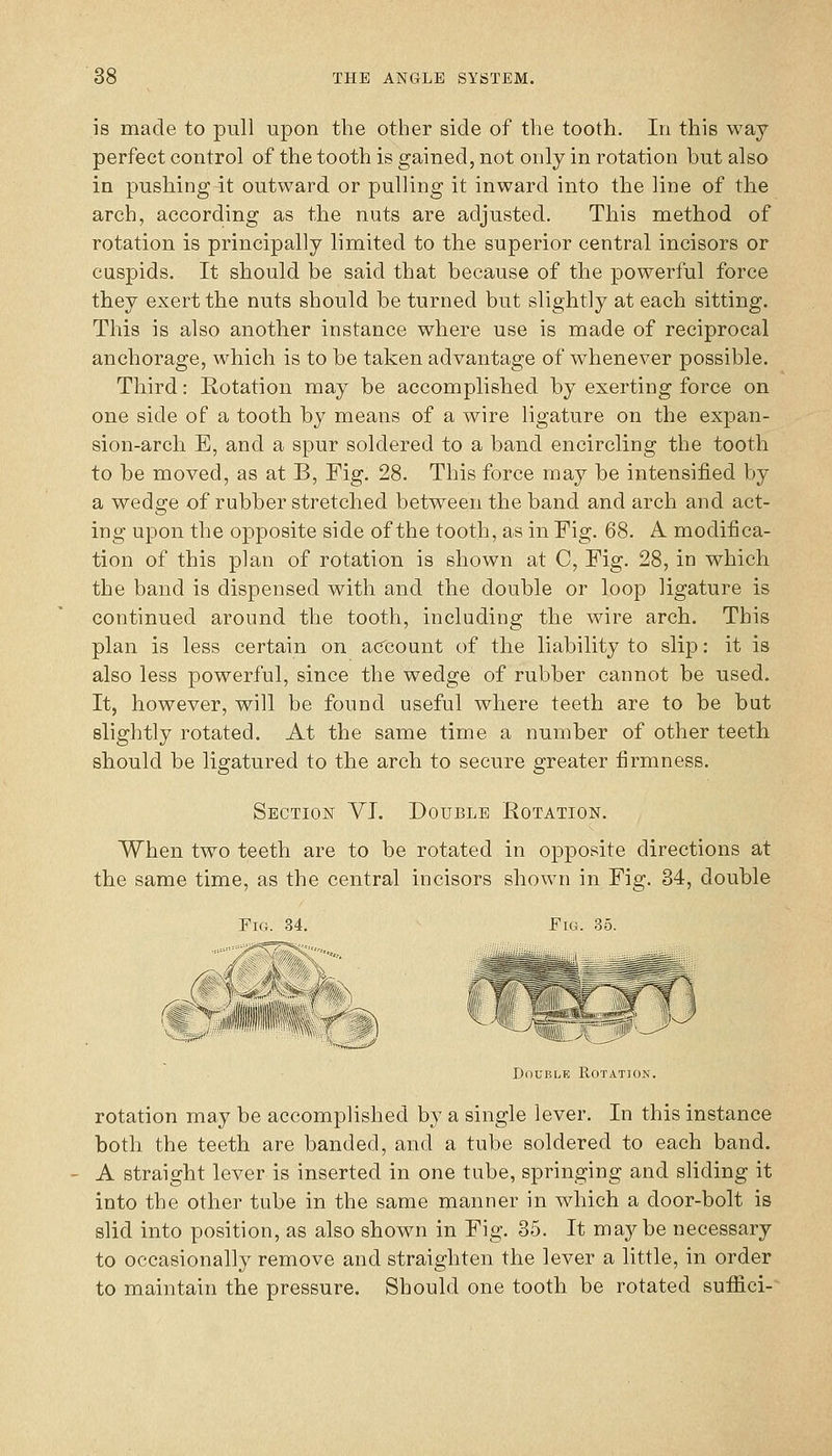 is made to pull upon the other side of the tooth. In this way- perfect control of the tooth is gained, not only in rotation but also in pushing it outward or pulling it inward into the line of the arch, according as the nuts are adjusted. This method of rotation is principally limited to the superior central incisors or cuspids. It should be said that because of the powerful force they exert the nuts should be turned but slightly at each sitting. This is also another instance where use is made of reciprocal anchorage, which is to be taken advantage of whenever possible. Third: Rotation may be accomplished by exerting force on one side of a tooth by means of a wire ligature on the expan- sion-arch E, and a spur soldered to a band encircling the tooth to be moved, as at B, Fig. 28. This force may be intensified by a wedge of rubber stretched between the band and arch and act- ing upon the opposite side of the tooth, as in Fig. 68. A modifica- tion of this plan of rotation is shown at C, Fig. 28, in which the band is dispensed with and the double or loop ligature is continued around the tooth, including the wire arch. This plan is less certain on account of the liability to slip: it is also less powerful, since the wedge of rubber cannot be used. It, however, will be found useful where teeth are to be but slightly rotated. At the same time a number of other teeth should be ligatured to the arch to secure greater firmness. Section VI. Double Rotation. When two teeth are to be rotated in opposite directions at the same time, as the central incisors shown in Fig. 34, double Fig. 34. Fig. 35. Double Rotation. rotation may be accomplished by a single lever. In this instance both the teeth are banded, and a tube soldered to each band. A straight lever is inserted in one tube, springing and sliding it into the other tube in the same manner in which a door-bolt is slid into position, as also shown in Fig. 35. It maybe necessary to occasionally remove and straighten the lever a little, in order to maintain the pressure. Should one tooth be rotated suffici-