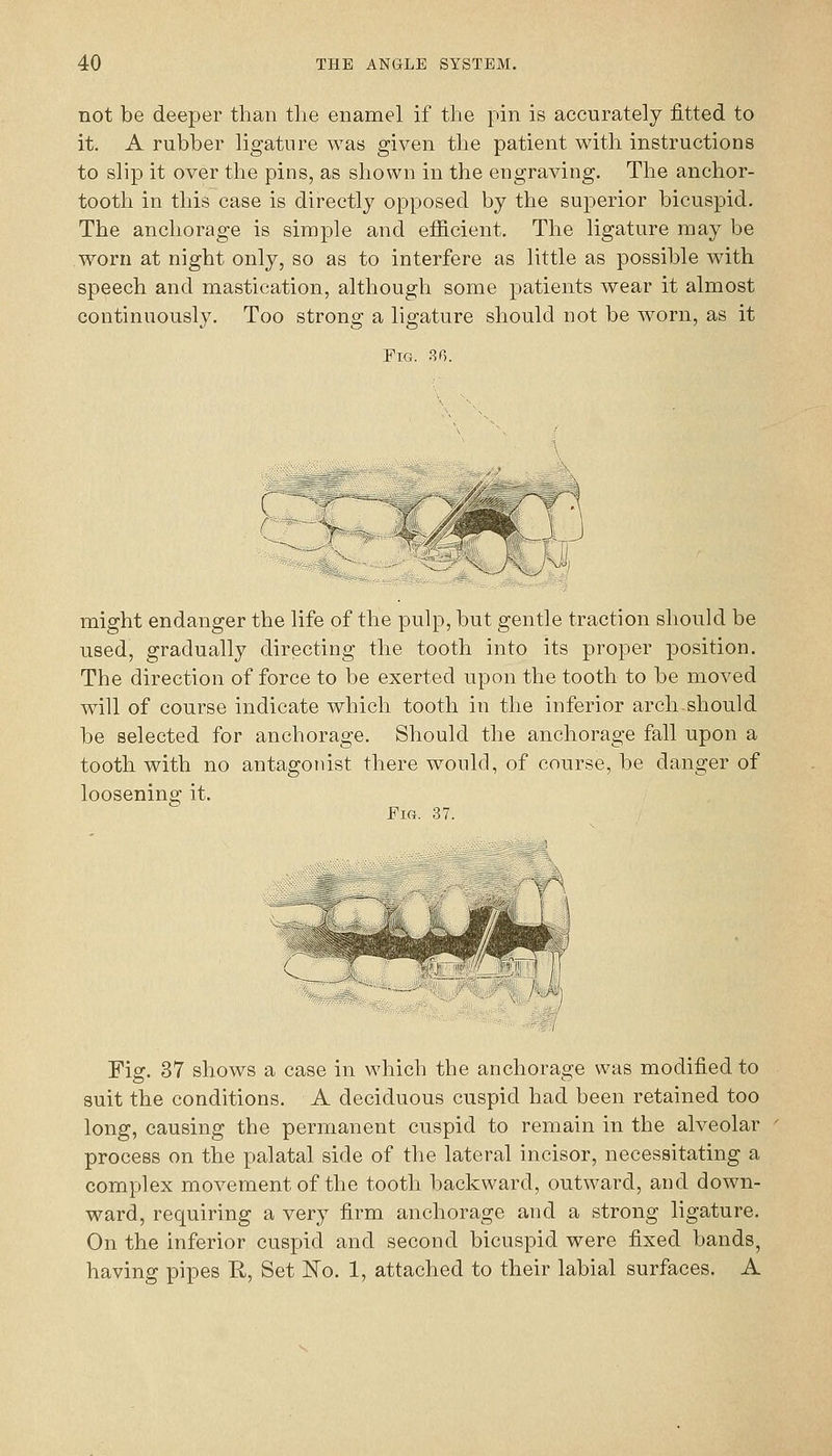 not be deeper than the enamel if the pin is accurately fitted to it. A rubber ligature was given the patient with instructions to slip it over the pins, as shown in the engraving. The anchor- tooth in this case is directly opposed by the superior bicuspid. The anchorage is simple and efficient. The ligature may be worn at night only, so as to interfere as little as possible with speech and mastication, although some patients wear it almost continuously. Too strong a ligature should not be worn, as it Fig. SG. r { might endanger the life of the pulp, but gentle traction should be used, gradually directing the tooth into its proper position. The direction of force to be exerted upon the tooth to be moved will of course indicate which tooth in the inferior arch.should be selected for anchorage. Should the anchorage fall upon a tooth with no antagonist there would, of course, be danger of loosening it. Fm. 37. Fig. 37 shows a case in which the anchorage was modified to suit the conditions. A deciduous cuspid had been retained too long, causing the permanent cuspid to remain in the alveolar process on the palatal side of the lateral incisor, necessitating a complex movement of the tooth backward, outward, and down- ward, requiring a very firm anchorage and a strong ligature. On the inferior cuspid and second bicuspid were fixed bands, having pipes R, Set No. 1, attached to their labial surfaces. A