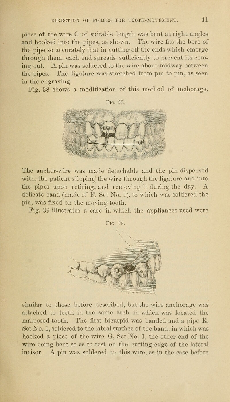 piece of the wire G of suitable length was bent at right angles and hooked into the pipes, as shown. The wire fits the bore of the pipe so accurately that in cutting off the ends which emerge through them, each end spreads sufficiently to prevent its com- ing out. A pin was soldered to the wire about midway between the pipes. The ligature was stretched from pin to pin, as seen in the engraving. Fig. 38 shows a modification of this method of anchorage. Pir;. 38. The anchor-wire was made detachable and the pin dispensed with, the patient slipping' the wire through the ligature and into the pipes upon retiring, and removing it during the day. A delicate band (made of F, Set IS'o. 1), to which was soldered the pin, was fixed on the moving tooth. Fig. 39 illustrates a case in which the appliances used were Fig 39. similar to those before described, but the wire anchorage was attached to teeth in the same arch in which was located the malposed tooth. The first bicuspid was banded and a pipe R, Set ISTo. 1, soldered to the labial surfVice of the band, in which was hooked a piece of the wire G, Set 'No. 1, the other end of the wire being bent so as to rest on the cutting-edge of the lateral incisor. A pin was soldered to this wire, as in the case before