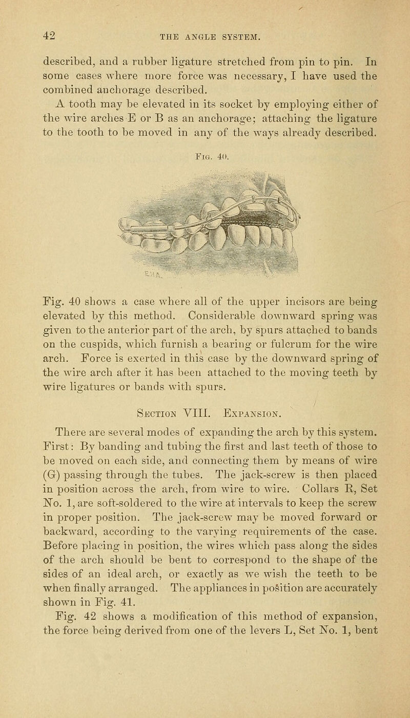 described, and a rubber ligature stretched from pin to pin. In some cases where more force was necessary, I have used the combined anchorage described. A tooth may be elevated in its socket by employing either of the wire arches E or B as an anchorage; attaching the ligature to the tooth to be moved in any of the ways already described. Fig. 40. Fig. 40 shows a case where all of the upper incisors are being elevated by this method. Considerable downward spring was given to the anterior part of the arch, by spurs attached to bands on the cuspids, which furnish a bearing or fulcrum for the wire arch. Force is exerted in this case by the downward spring of the wire arch after it has been attached to the moving teeth by wire ligatures or bands with spurs. Section VIII. Expansion. There are several modes of expanding the arch by this system. First: By banding and tubing the first and last teeth of those to be moved on each side, and connecting them by means of wire (G) passing through the tubes. The jack-screw is then placed in position across the arch, from wire to wire. Collars E>, Set ISTo. 1, are soft-soldered to the wire at intervals to keep the screw in proper position. The jack-screw may be moved forward or backward, according to the varying requirements of the case. Before placing in position, the wires which pass along the sides of the arch should be bent to correspond to the shape of the sides of an ideal arch, or exactly as we wish the teeth to be when finally arranged. The appliances in position are accurately shown in Fig. 41. Fig. 42 shows a modification of this method of expansion, the force being derived from one of the levers L, Set ISTo. 1, bent