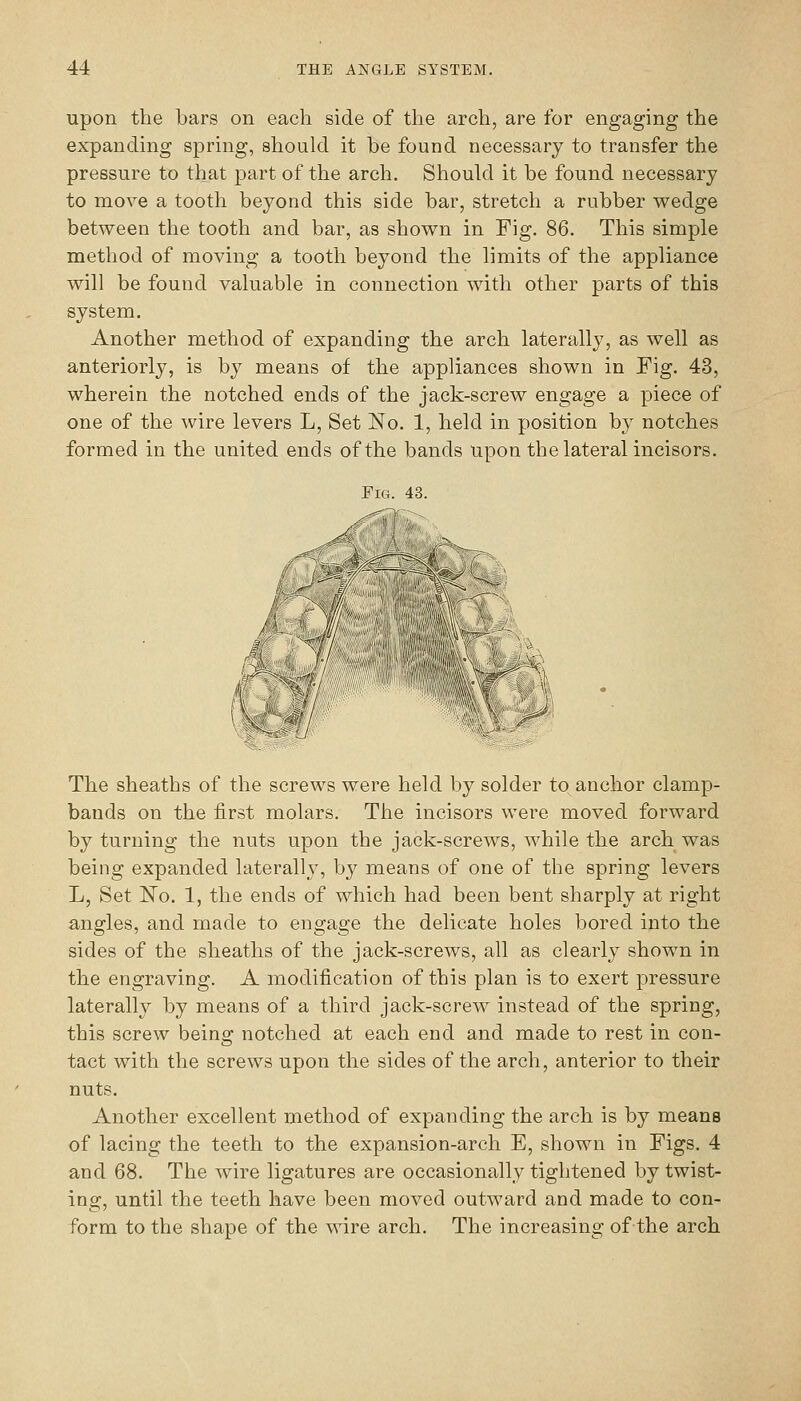 upon the bars on each side of the arch, are for engaging the expanding spring, should it be found necessary to transfer the pressure to that part of the arch. Should it be found necessary to move a tooth beyond this side bar, stretch a rubber wedge between the tooth and bar, as shown in Fig. 86. This simple method of moving a tooth beyond the limits of the appliance will be found valuable in connection with other parts of this system. Another method of expanding the arch laterally, as well as anteriorly, is by means of the appliances shown in Fig. 43, wherein the notched ends of the jack-screw engage a piece of one of the wire levers L, Set No. 1, held in position by notches formed in the united ends of the bands upon the lateral incisors. Fig. 43. The sheaths of the screws were held by solder to anchor clamp- bauds on the first molars. The incisors were moved forward by turning the nuts upon the jack-screws, while the arch was being expanded laterally, by means of one of the spring levers L, Set No. 1, the ends of which had been bent sharply at right angles, and made to engage the delicate holes bored into the sides of the sheaths of the jack-screws, all as clearly shown in the engraving. A modification of this plan is to exert pressure laterally by means of a third jack-screw instead of the spring, this screw being notched at each end and made to rest in con- tact with the screws upon the sides of the arch, anterior to their nuts. Another excellent method of expanding the arch is by means of lacing the teeth to the expansion-arch E, shown in Figs. 4 and 68. The wire ligatures are occasionally tightened by twist- ing, until the teeth have been moved outward and made to con- form to the shape of the wire arch. The increasing of the arch