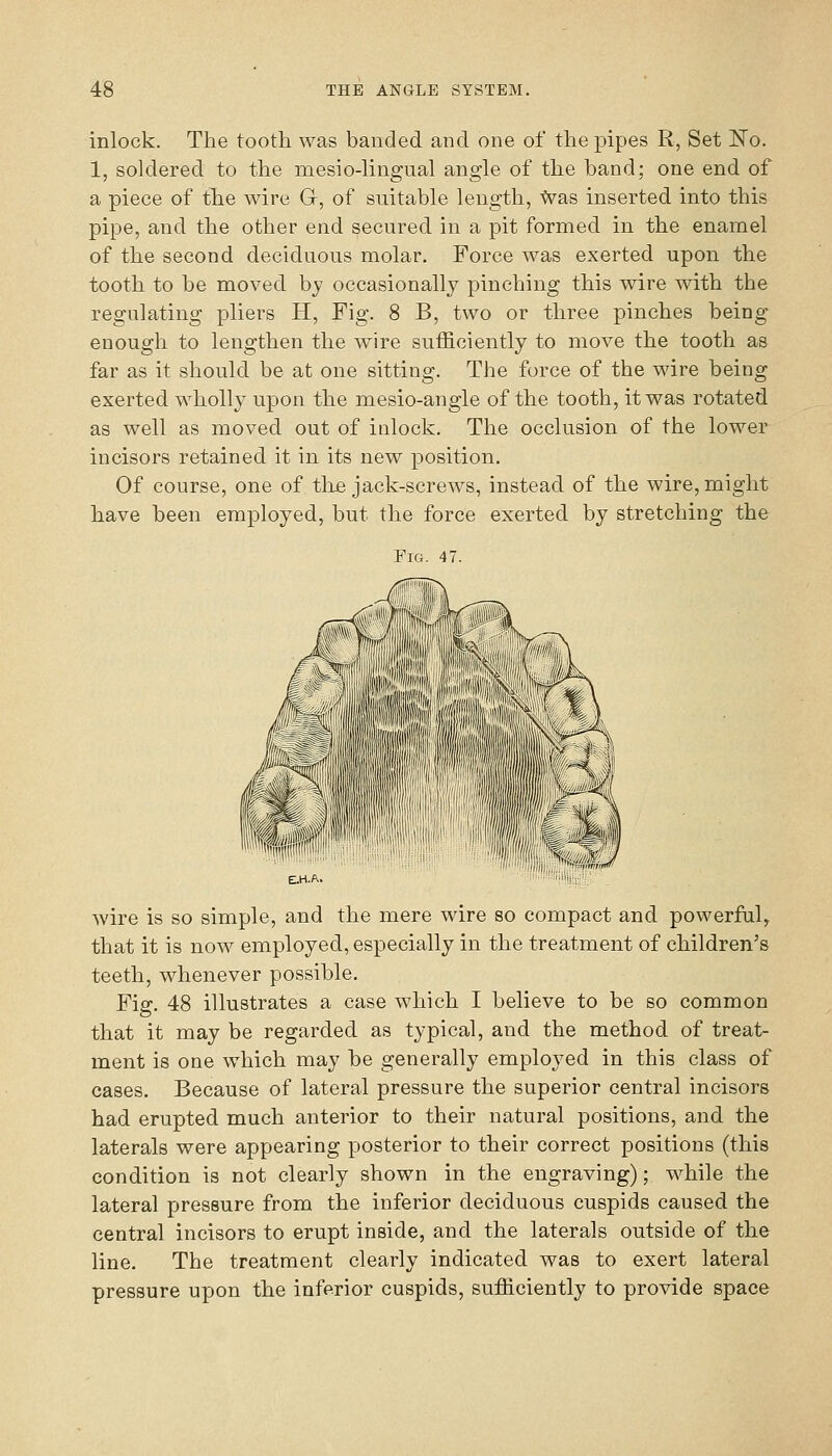 inlock. The tooth was banded and one of the pipes R, Set IsTo. 1, soldered to the mesio-lingual angle of the band; one end of a piece of the wire G, of suitable length, tvas inserted into this pipe, and the other end secured in a pit formed in the enamel of the second deciduous molar. Force was exerted upon the tooth to be moved by occasionally pinching this wire with the regulating pliers H, Fig. 8 B, two or three pinches being enough to lengthen the wire sufficiently to move the tooth as far as it should be at one sitting. The force of the wire being exerted wholly upon the mesio-angle of the tooth, it was rotated as well as moved out of inlock. The occlusion of the lower incisors retained it in its new position. Of course, one of thje jack-screws, instead of the wire, might have been employed, but the force exerted by stretching the Fig. 47. wire is so simple, and the mere wire so compact and powerful, that it is now employed, especially in the treatment of children's teeth, whenever possible. Fig. 48 illustrates a case which I believe to be so common that it may be regarded as typical, and the method of treat- ment is one which may be generally employed in this class of cases. Because of lateral pressure the superior central incisors had erupted much anterior to their natural positions, and the laterals were appearing posterior to their correct positions (this condition is not clearly shown in the engraving); while the lateral pressure from the inferior deciduous cuspids caused the central incisors to erupt inside, and the laterals outside of the line. The treatment clearly indicated was to exert lateral pressure upon the inferior cuspids, sufficiently to provide space