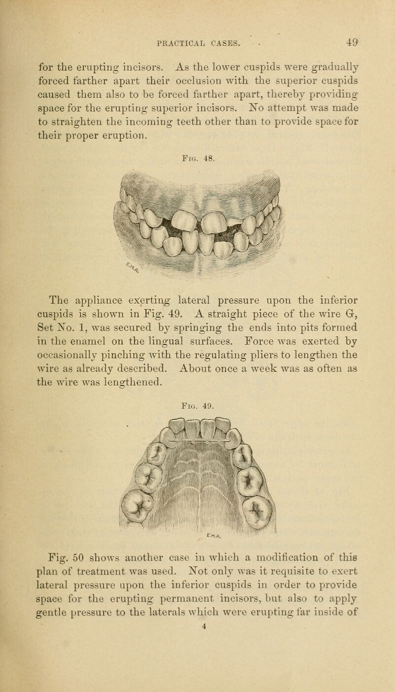 for the erupting incisors. As the lower cuspids were gradually- forced farther apart their occlusion with the superior cuspids caused them also to be forced farther apart, thereby providing space for the erupting superior incisors. ISTo attempt was made to straighten the incoming teeth other than to provide space for their proper eruption. Fig. 48. The appliance exerting lateral pressure upon the inferior cuspids is shown in Fig. 49. A straight piece of the wire G, Set Xo. 1, was secured by springing the ends into pits formed in the enamel on the lingual surfaces. Force was exerted by occasionally pinching with the regulating pliers to lengthen the wire as already described. About once a week was as often as the wire was lengthened. Fig. 49. Fig. 50 shows another case in which a modification of this plan of treatment was used. I^ot only was it requisite to exert lateral pressure upon the inferior cuspids in order to provide space for the erupting permanent incisors, but also to apply gentle pressure to the laterals which were erupting far inside of 4