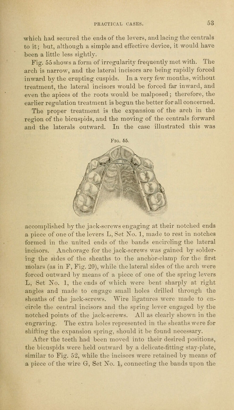 which had secured the ends of the levers, and lacing the centrals to it; but, although a simple and effective device, it would have been a little less sightly. Fig. 55 shows a form of irregularity frequently met with. The arch is narrow, and the lateral incisors are being rapidly forced inward by the erupting cuspids. In a very few months, without treatment, the lateral incisors would be forced far inward, and even the apices of the roots would be malposed; therefore, the earlier regulation treatment is begun the better for all concerned. The proper treatment is the expansion of the arch in the region of the bicuspids, and the moving of the centrals forward and the laterals outward. In the case illustrated this was accomplished by the jack-screws engaging at their notched ends a piece of one of the levers L, Set No. 1, made to rest in notches formed in the united ends of the bands encircling the lateral incisors. Anchorage for the jack-screws was gained by solder- ing the sides of the sheaths to the anchbr-clamp for the first molars (as in F, Fig. 20), while the lateral sides of the arch were forced outward by means of a piece of one of the spring levers L, Set No. 1, the ends of which were bent sharply at right angles and made to engage small holes drilled through the sheaths of the jack-screws. Wire ligatures were made to en- circle the central incisors and the spring lever engaged by the notched points of the jack-screws. All as clearly shown in the engraving. The extra holes represented in the sheaths were for shifting the expansion spring, should it be found necessary. After the teeth had been moved into their desired positions, the bicuspids were held outward by a delicate-fitting stay-plate, similar to Fig. 52, while the incisors were retained by means of a piece of the wire G, Set l^o. 1, connecting the bands upon the