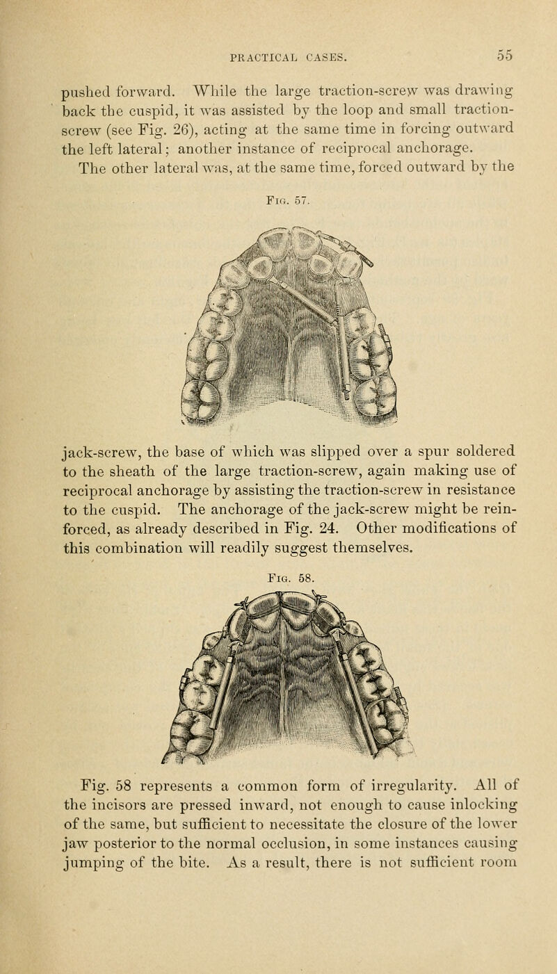 pushed forward. While the large traction-screw was drawing back the cuspid, it was assisted by the loop and small traction- screw (see Fig. 26), acting at the same time in forcing outward the left lateral; another instance of reciprocal anchorage. The other lateral was, at the same time, forced outward by the Fig. 57. ')'^' jack-screw, the base of which was slipped over a spur soldered to the sheath of the large traction-screw, again making use of reciprocal anchorage by assisting the traction-screw in resistance to the cuspid. The anchorage of the jack-screw might be rein- forced, as already described in Fig. 24. Other modifications of this combination will readily suggest themselves. Fig. 58. Fig. 58 represents a common form of irregularity. All of the incisors are pressed inward, not enough to cause inlocking of the same, but suflScientto necessitate the closure of the lower jaw posterior to the normal occlusion, in some instances causing jumping of the bite. As a result, there is not sufficient room